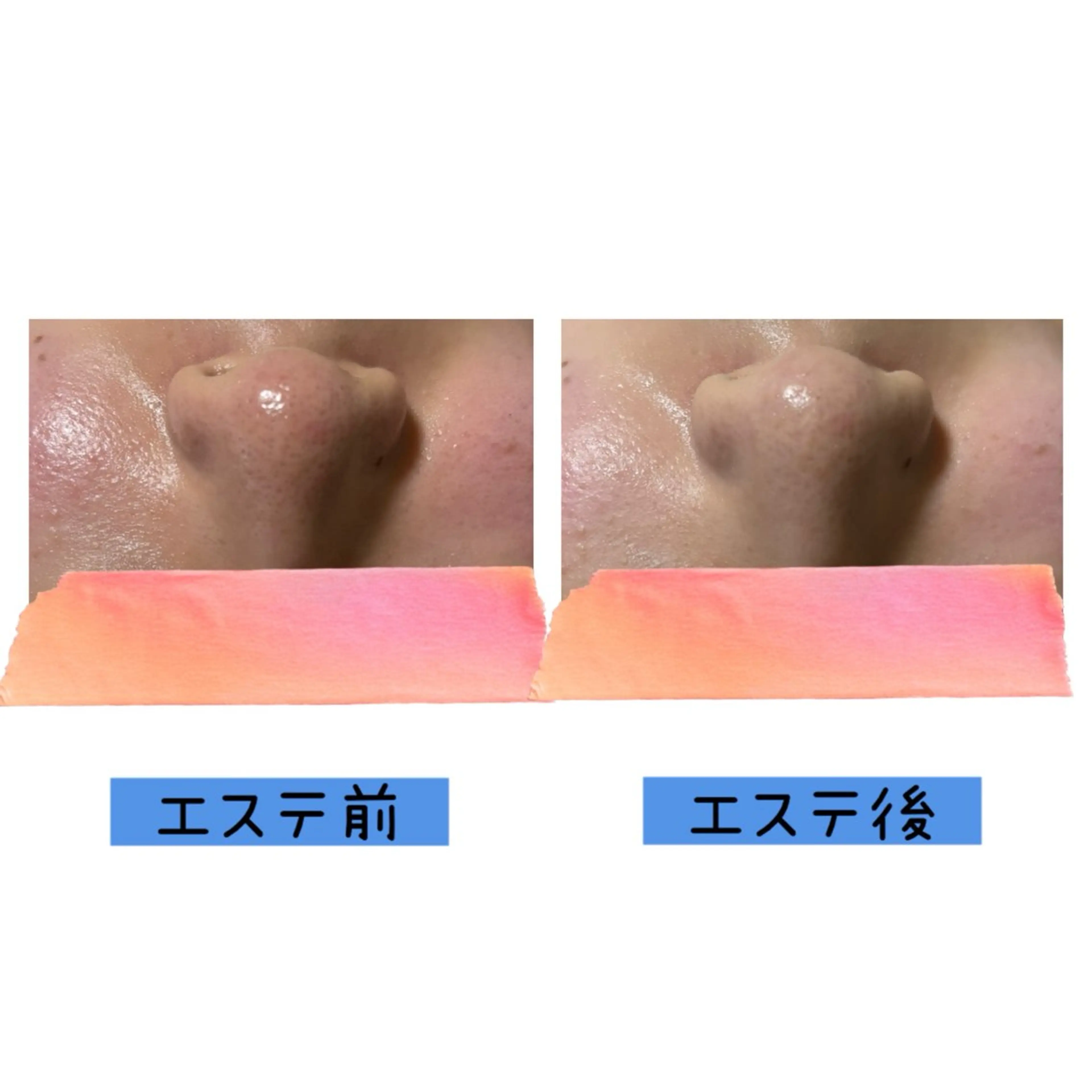 【初回限定】毛穴すっきり フェイシャル60分 ¥3,500／通常¥5,000の写真