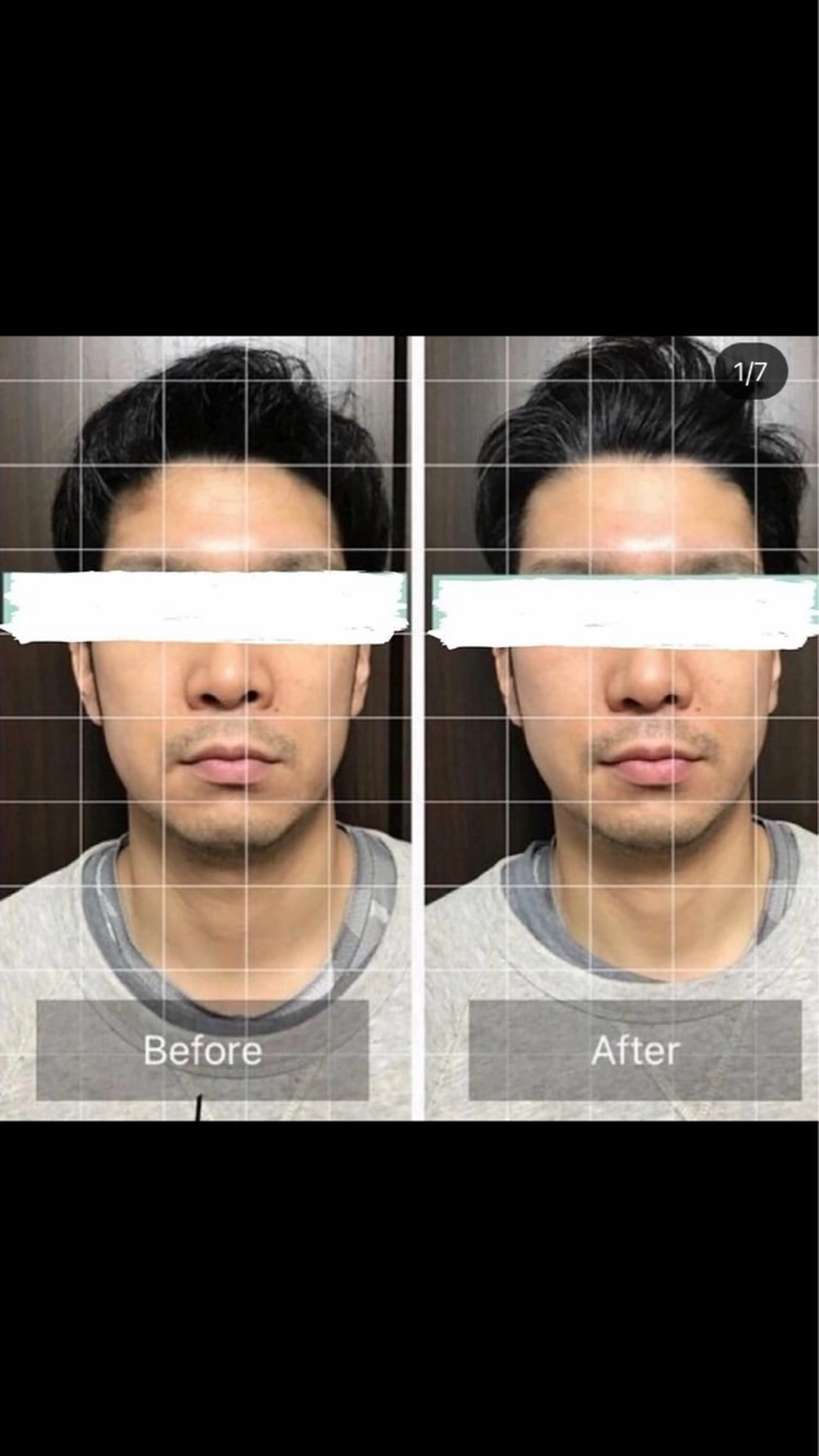 脳洗浄ドライヘッドスパの写真