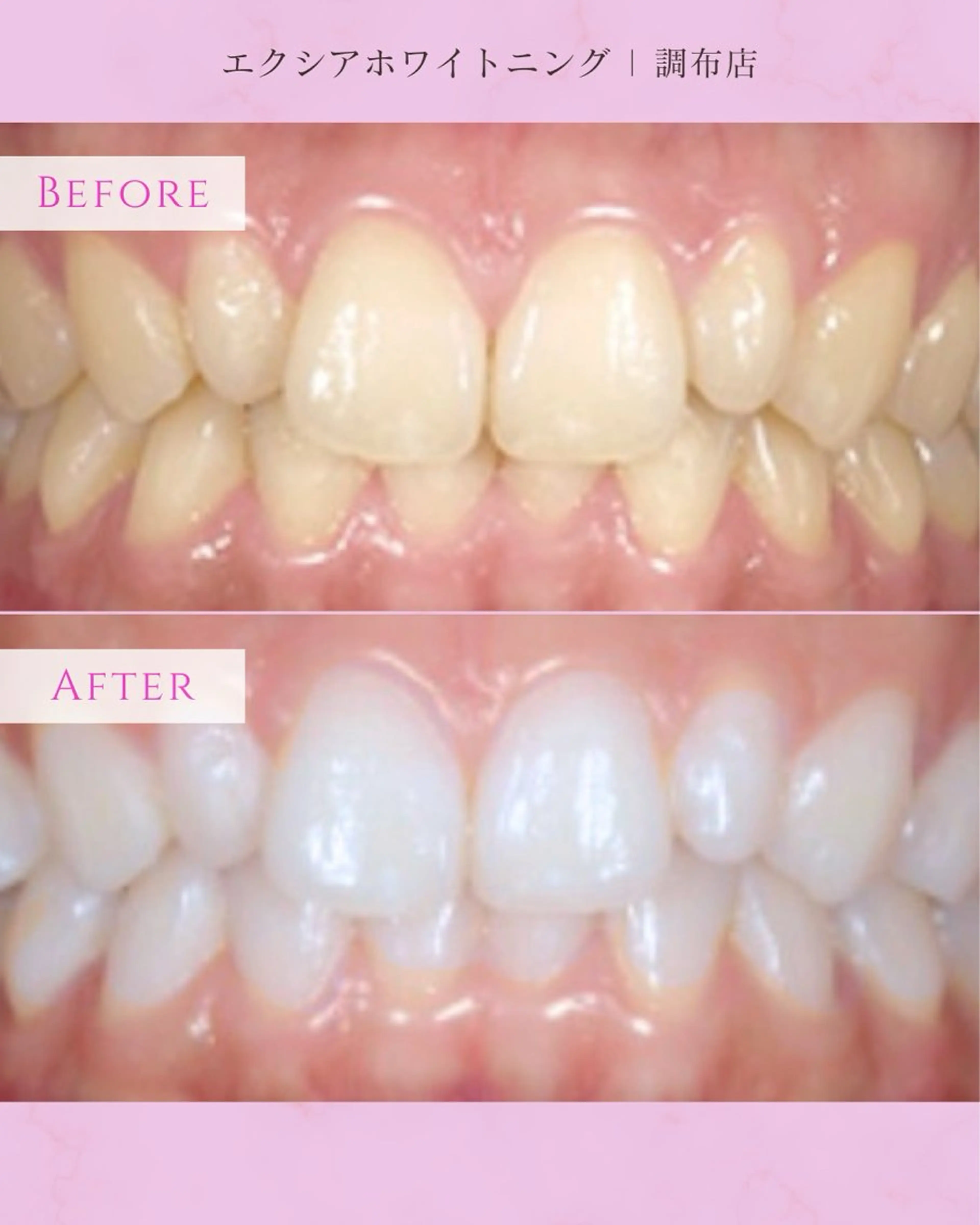 エクシアホワイト調布所属・umi❤︎ ホワイトニングのその他イメージ