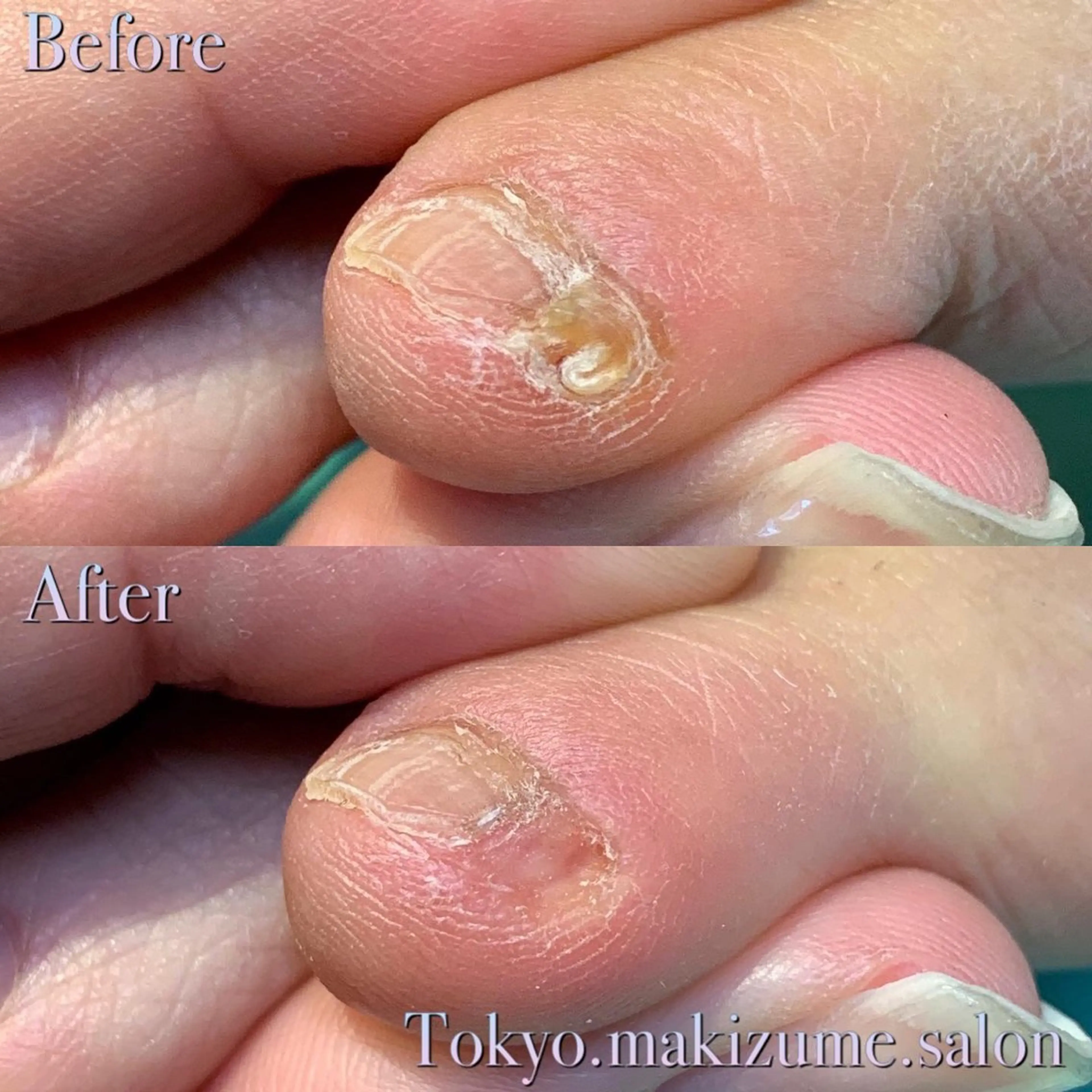 【副爪ケア】2か所✨小指の爪横にある爪みたいなモノ💡キレイに除去し、痛みや違和感を改善🦶🏻の写真