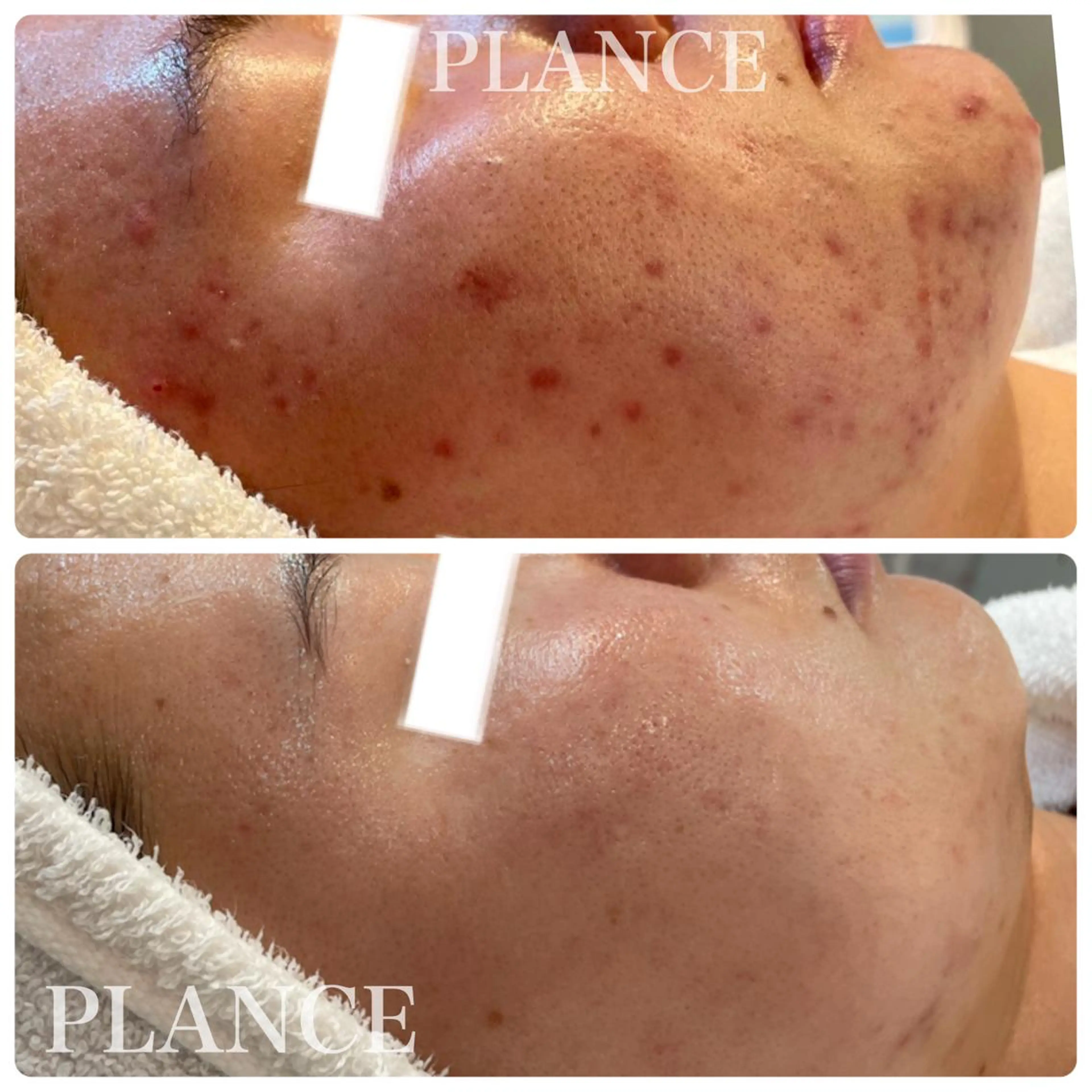 エステ フェイシャル専門 肌質改善/プランスのエステ・リラクイメージ