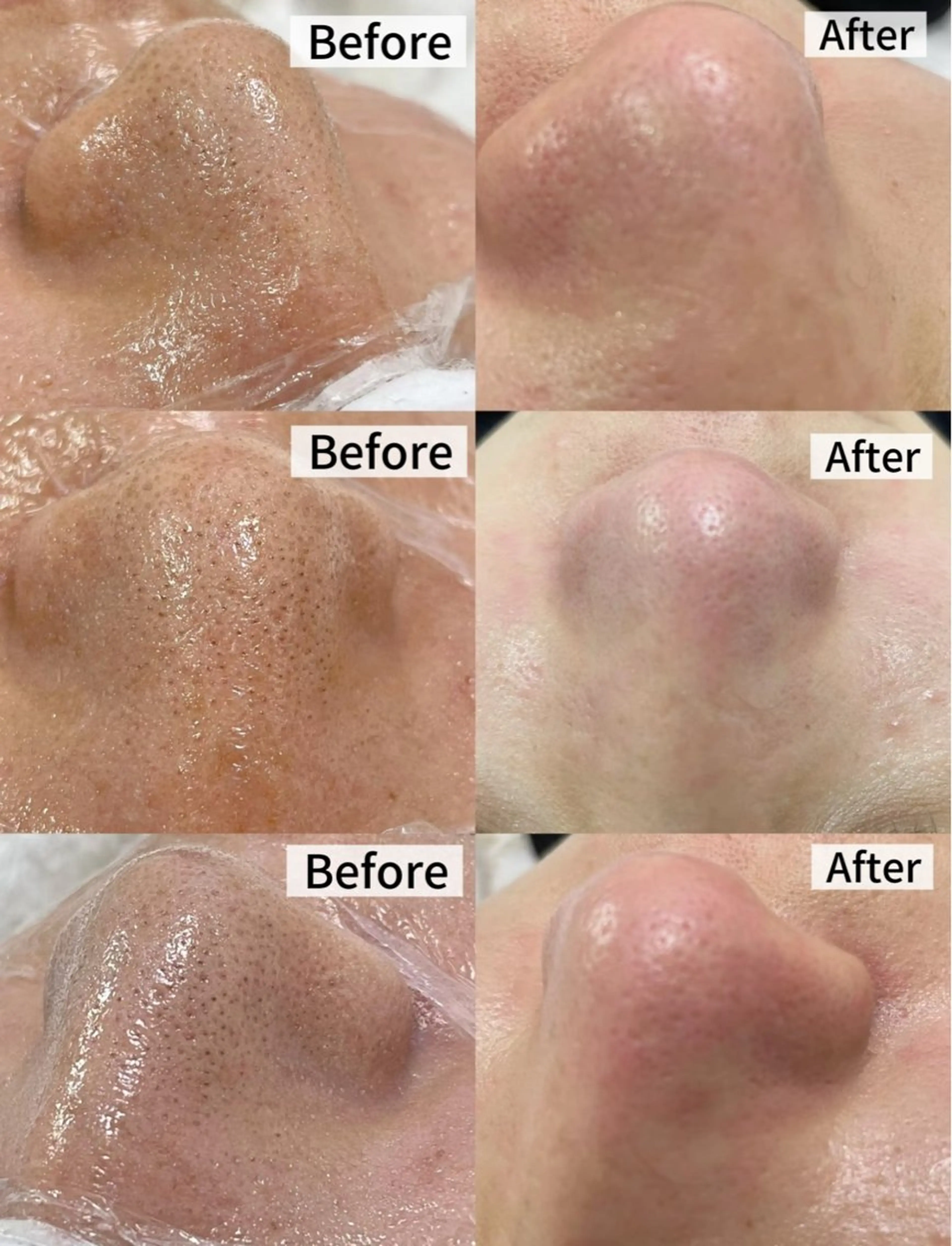 人気No.1【毛穴レス&もちもち理想肌】毛穴洗浄✕潤いフルケア60分の写真