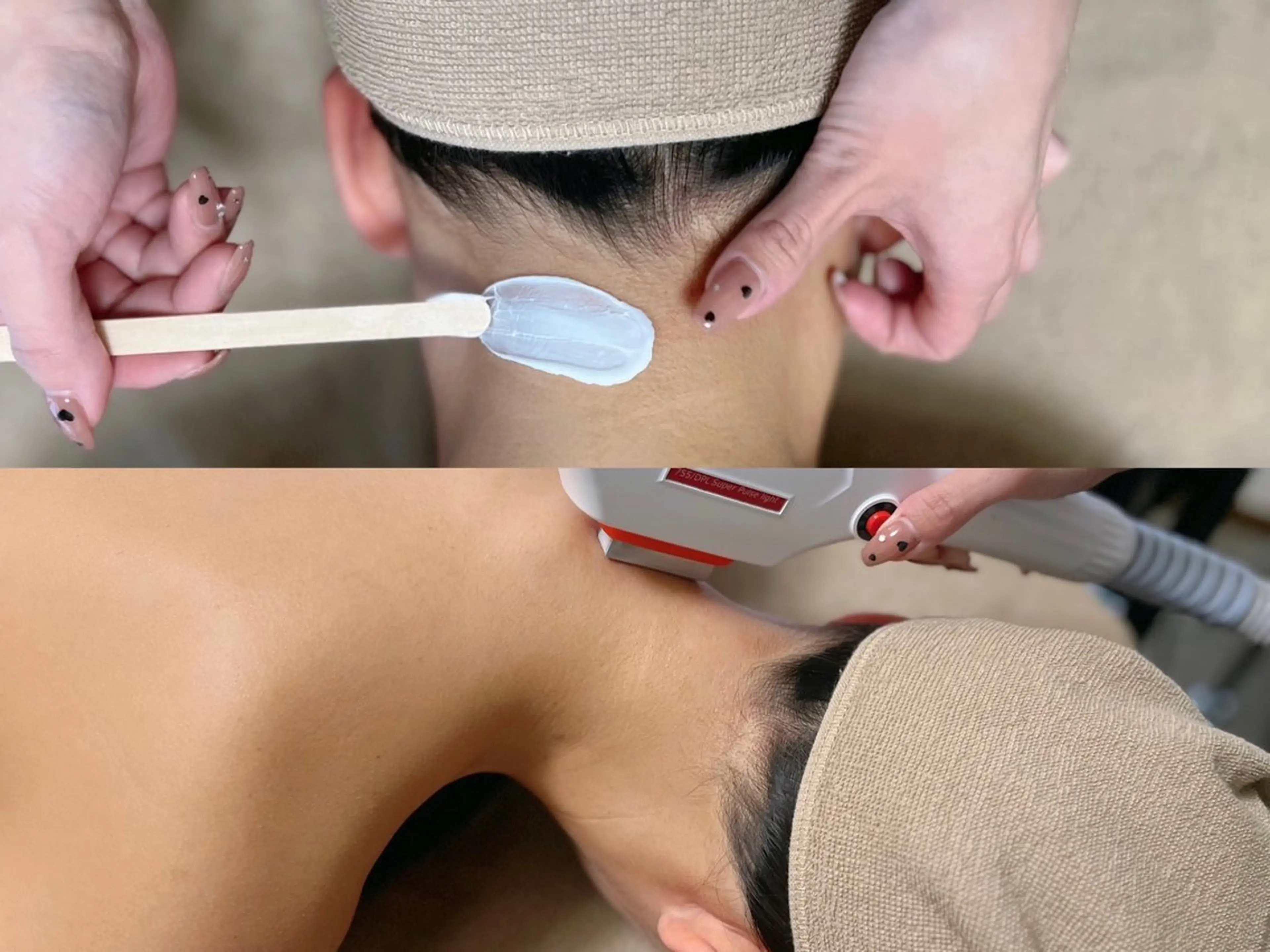 【うなじMIX脱毛】¥7,000→¥4,300 後ろ姿美人に🤍の写真