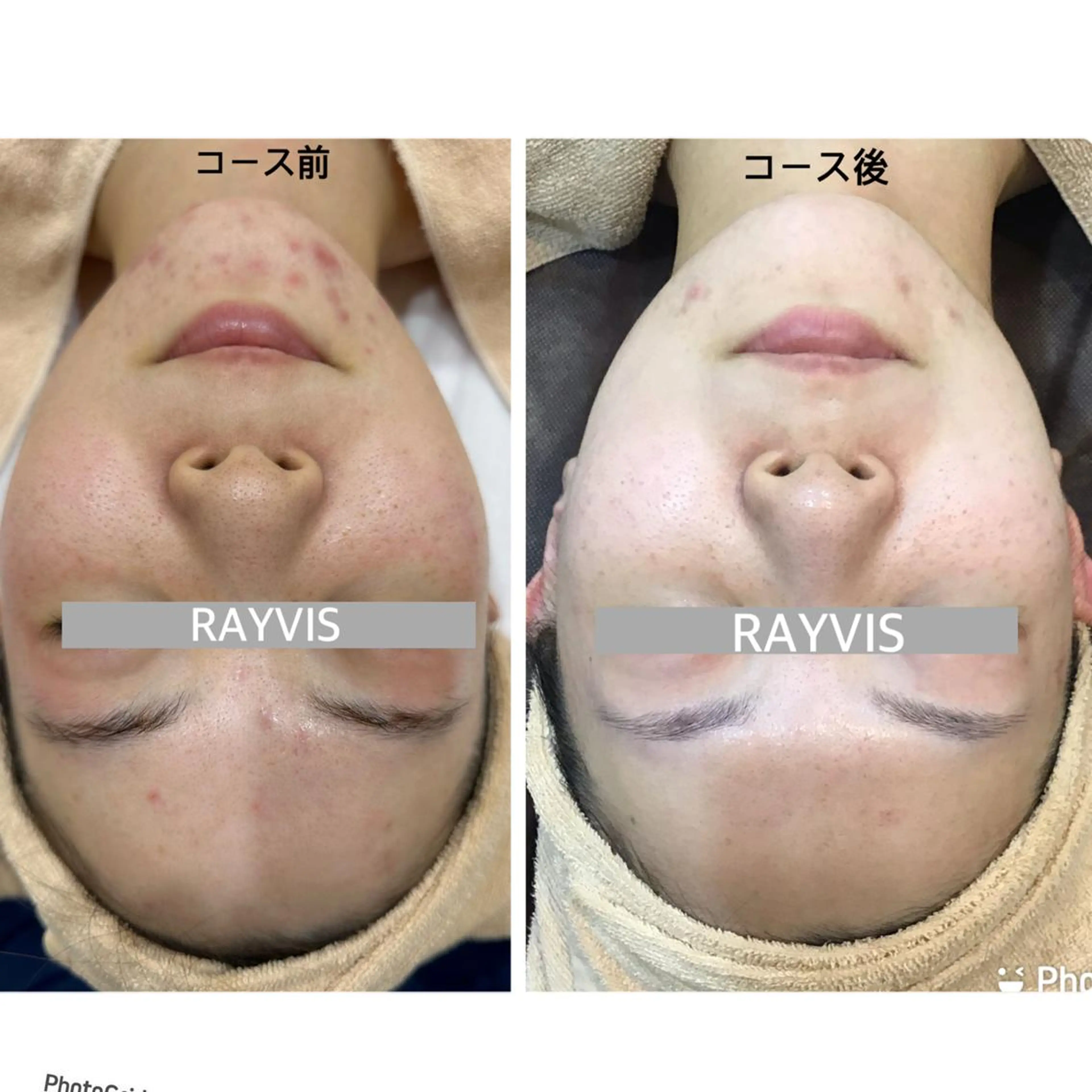 【人気No１】美肌顔脱毛！IPL脱毛！シェービング付💕毛穴＆保湿＆美白✨の写真