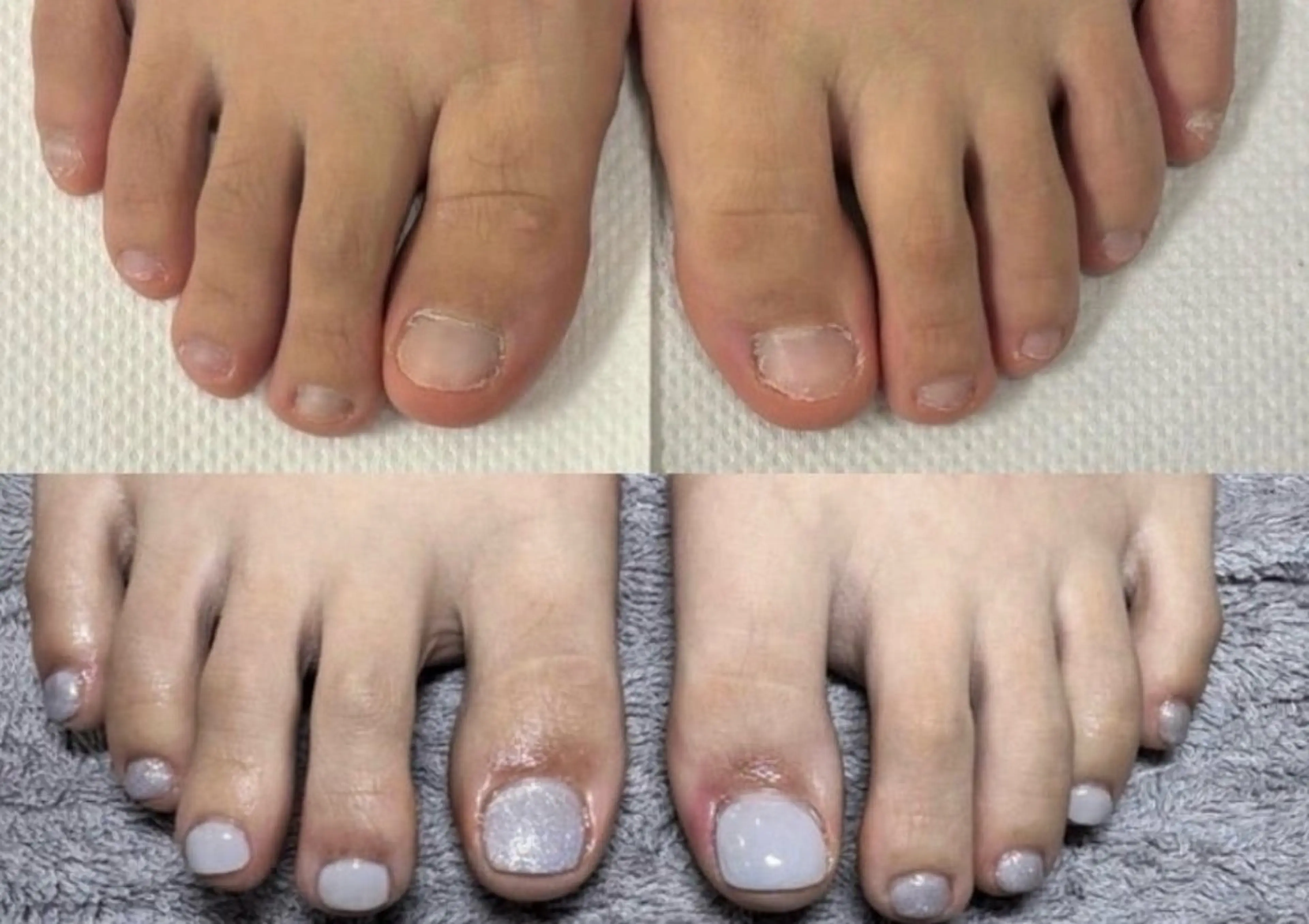 ネイル フットネイル ジェルネイル 深爪矯正専門サロン　ルソア所属・深爪矯正専門サロン ルソアのネイルデザイン