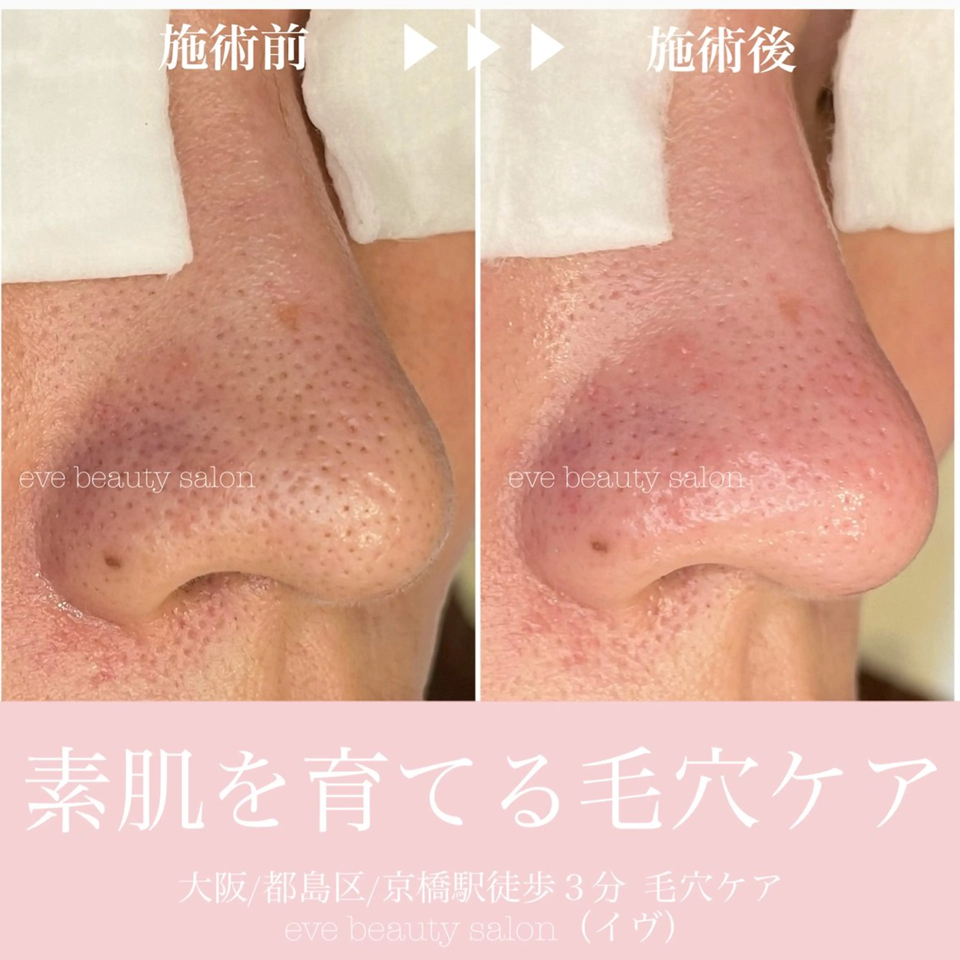 秋のくすみ肌・毛穴悩み改善コースの写真