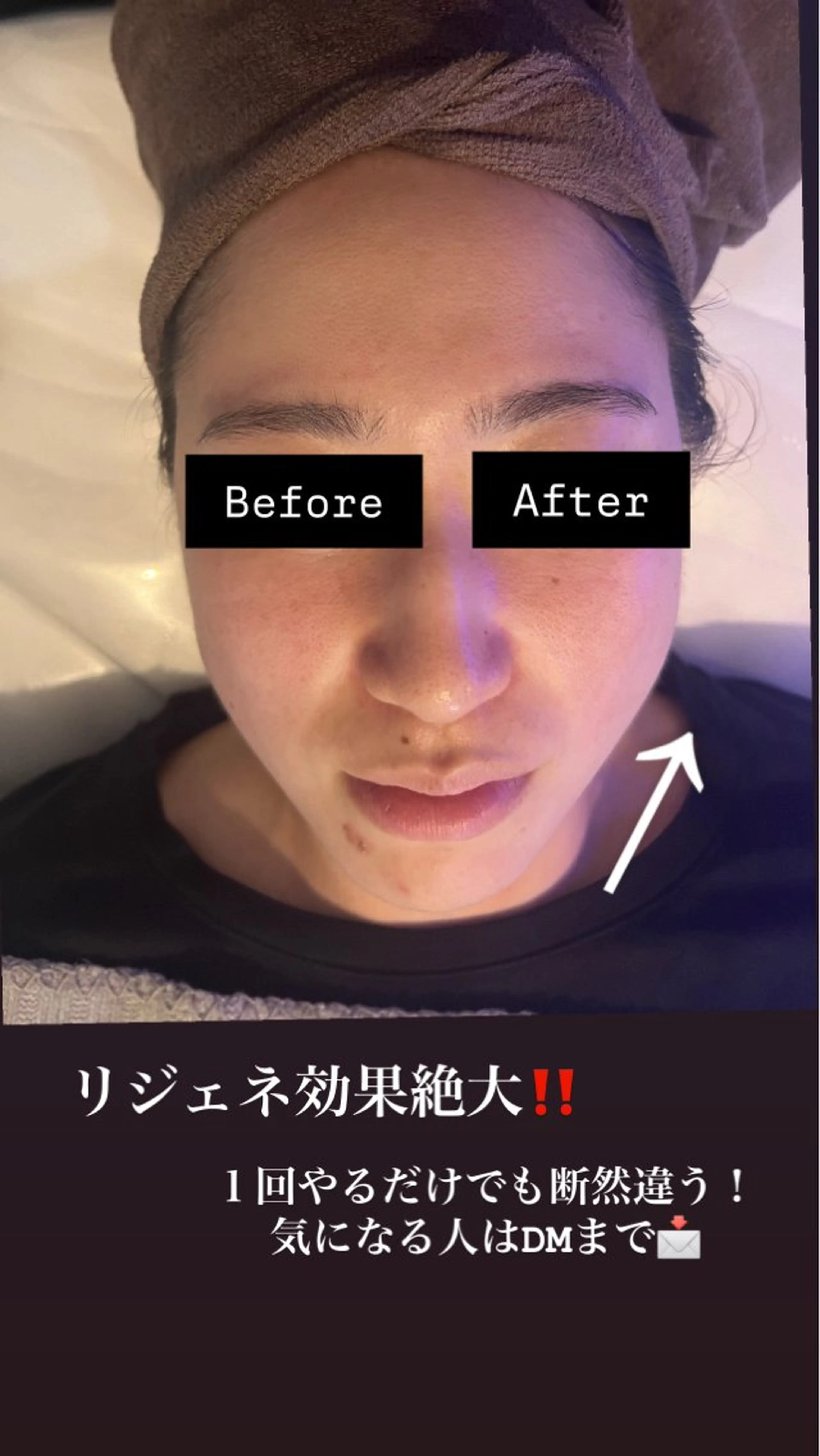 《糸リフト不要‼️》効果1ヶ月持つ✨リジェネ✨当店でしか味わえないリフトアップの写真