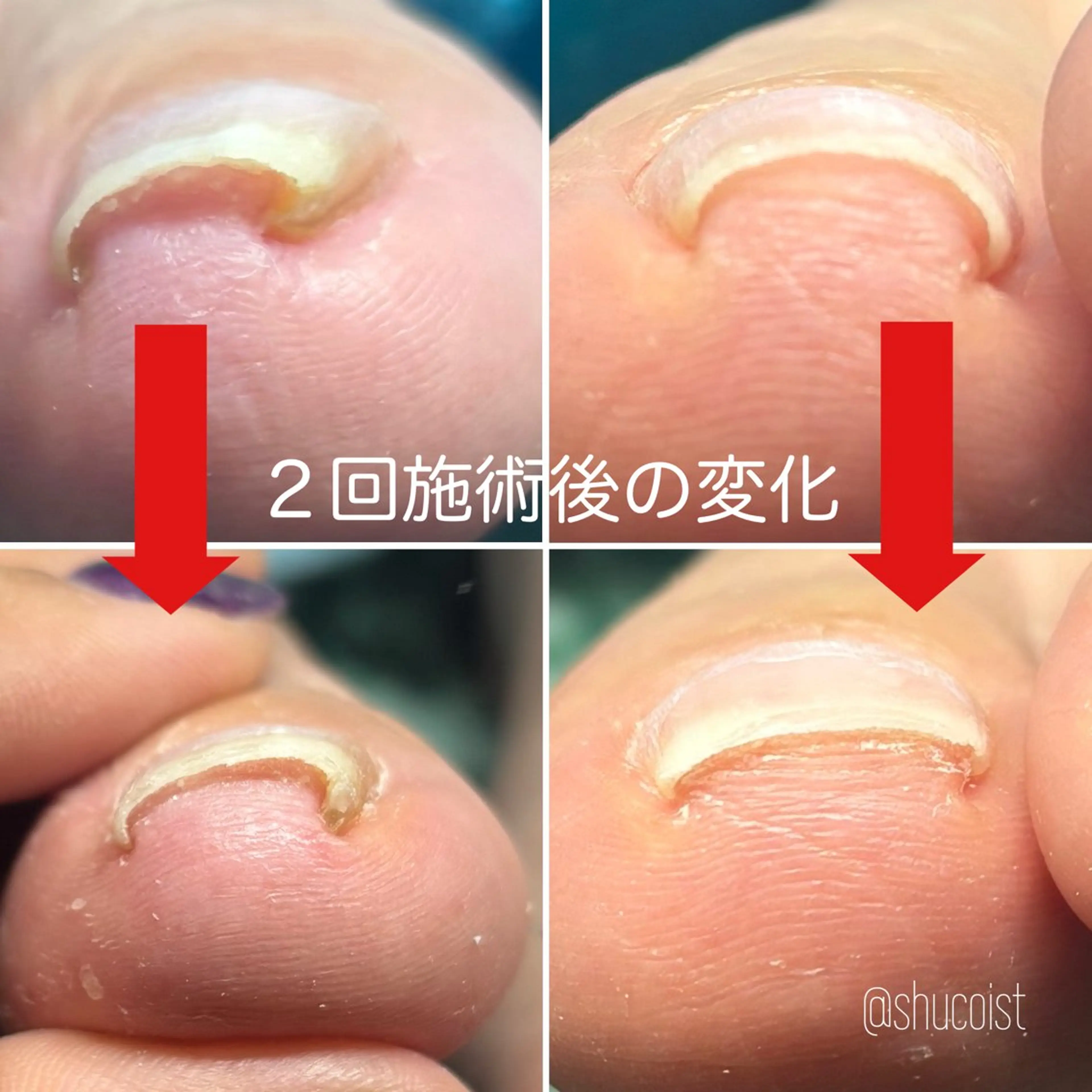 【3回コース】巻き爪ケア【メンズOK◎】の写真