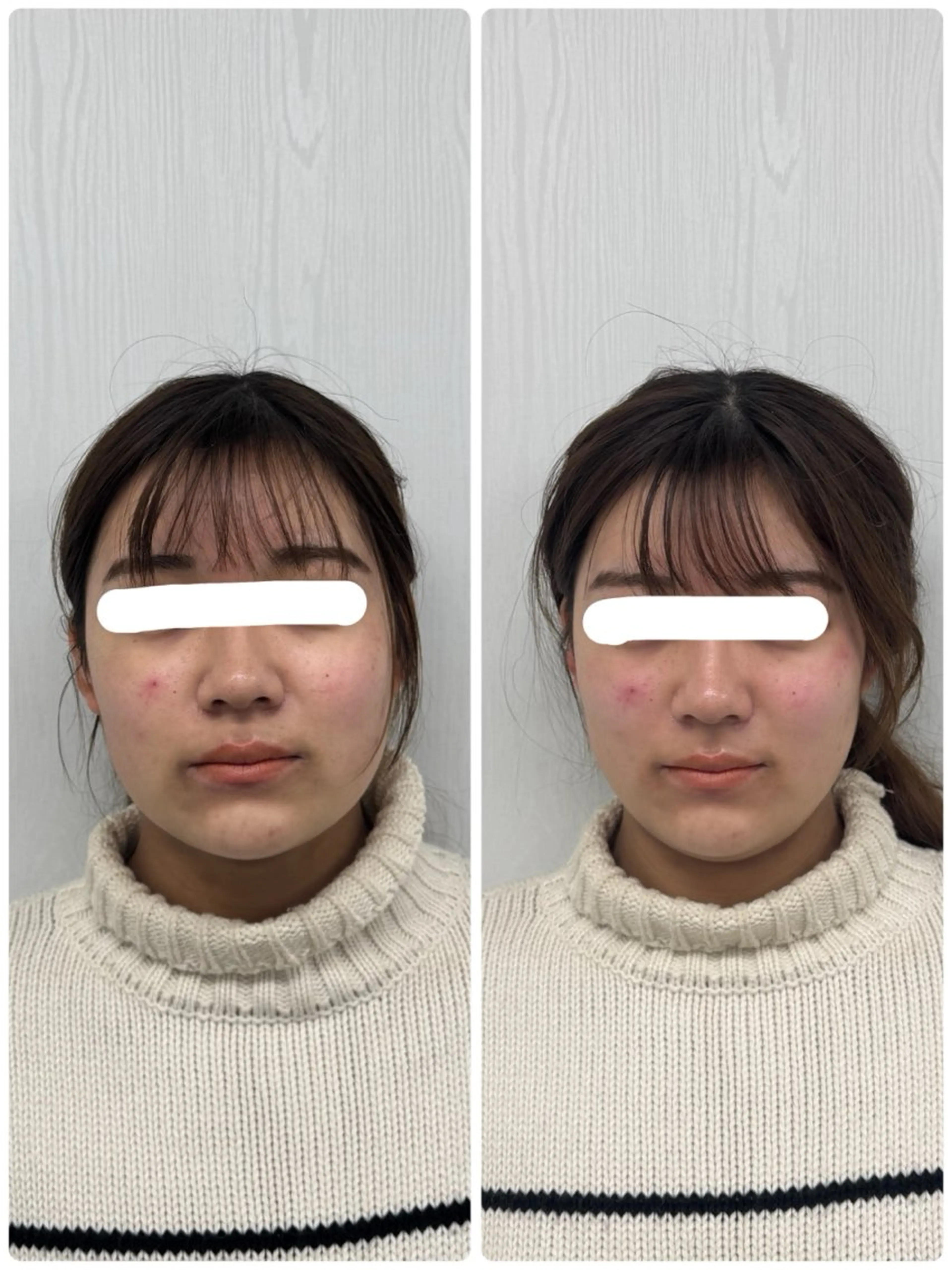 美容鍼×小顔矯正 ×美容整体　浜川泰仁のエステ・リラクイメージ