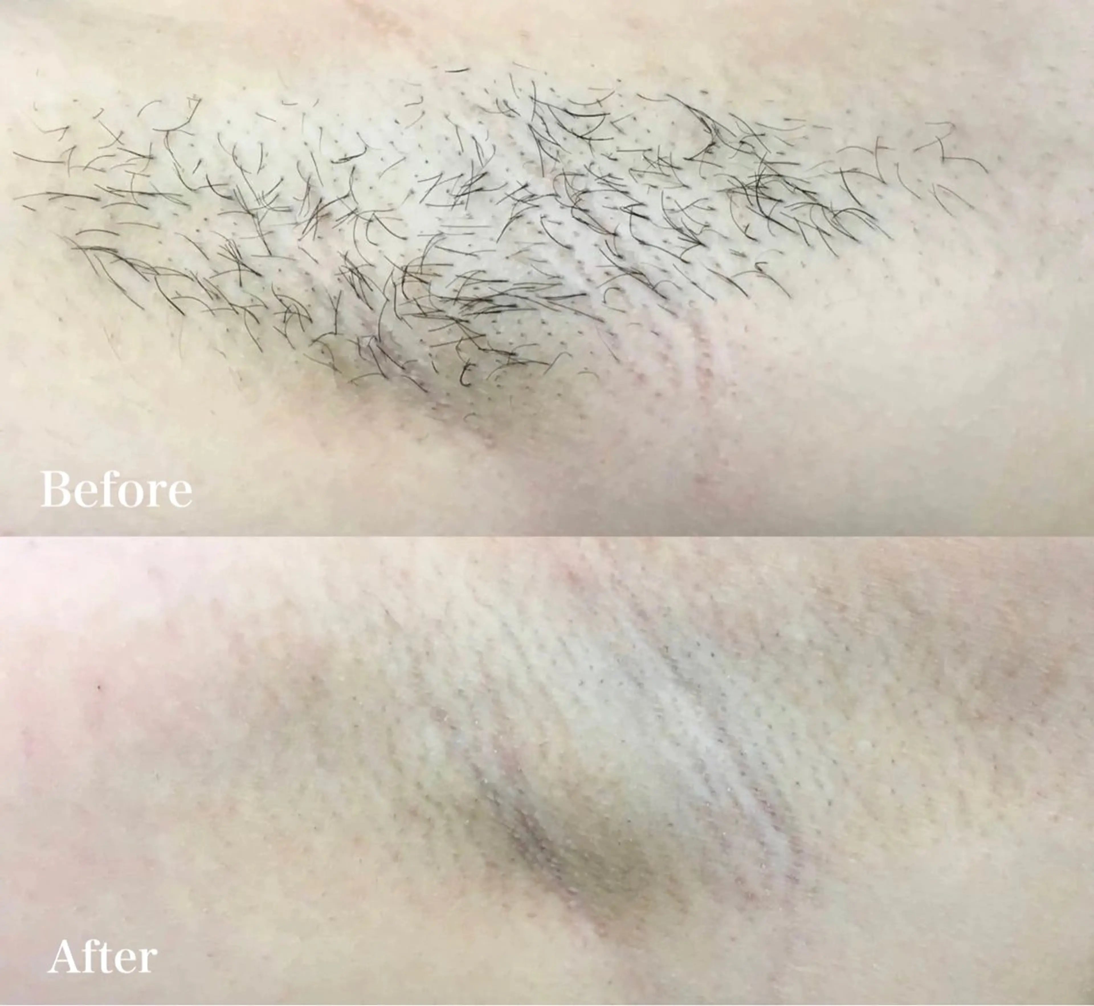 VIO /美肌専門サロン【Beauty  salon Bibiy】所属・VIO美肌専門サロン Bibiyのエステ・リラクイメージ