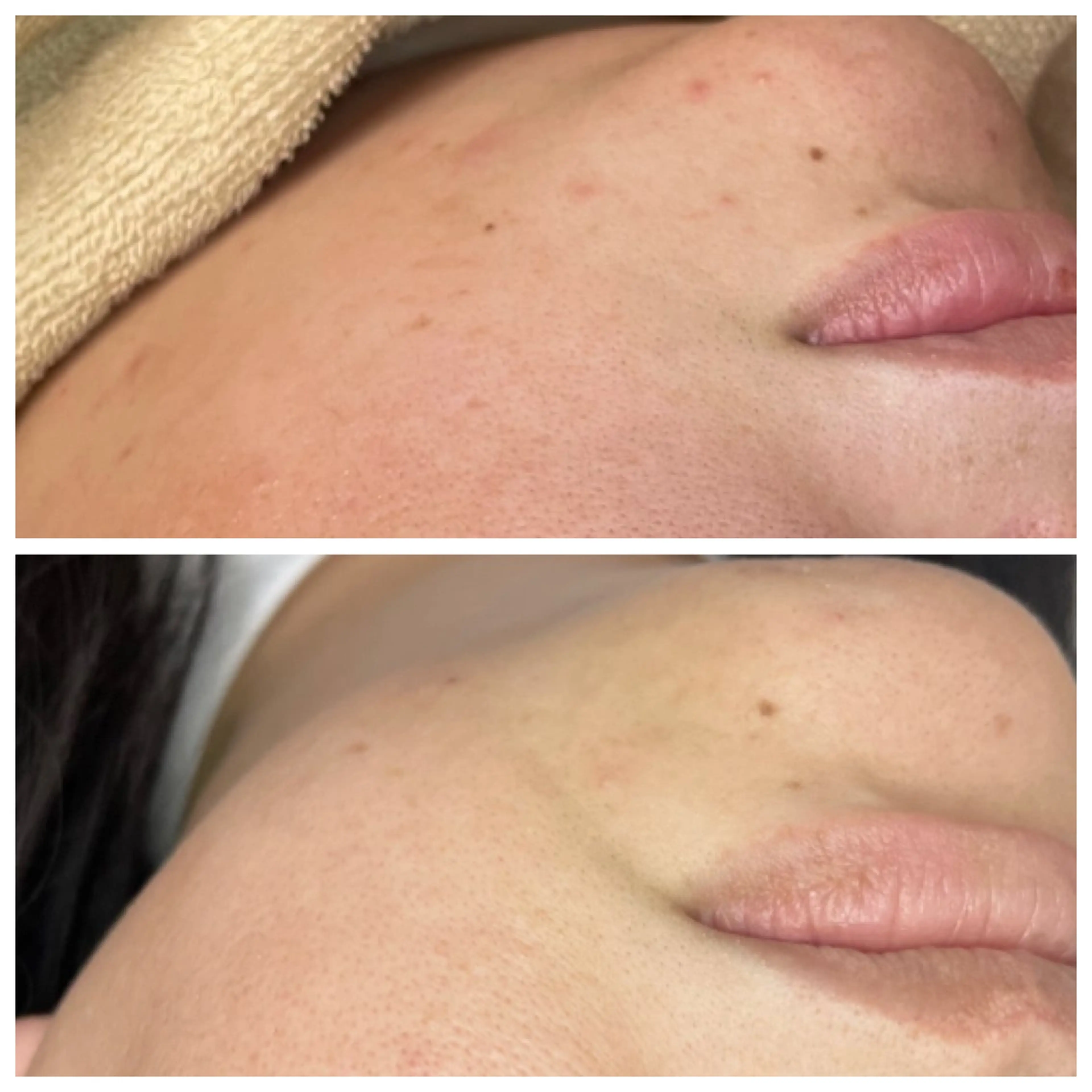 ニキビ/敏感肌/乾燥 Lilyauraのエステ・リラクイメージ