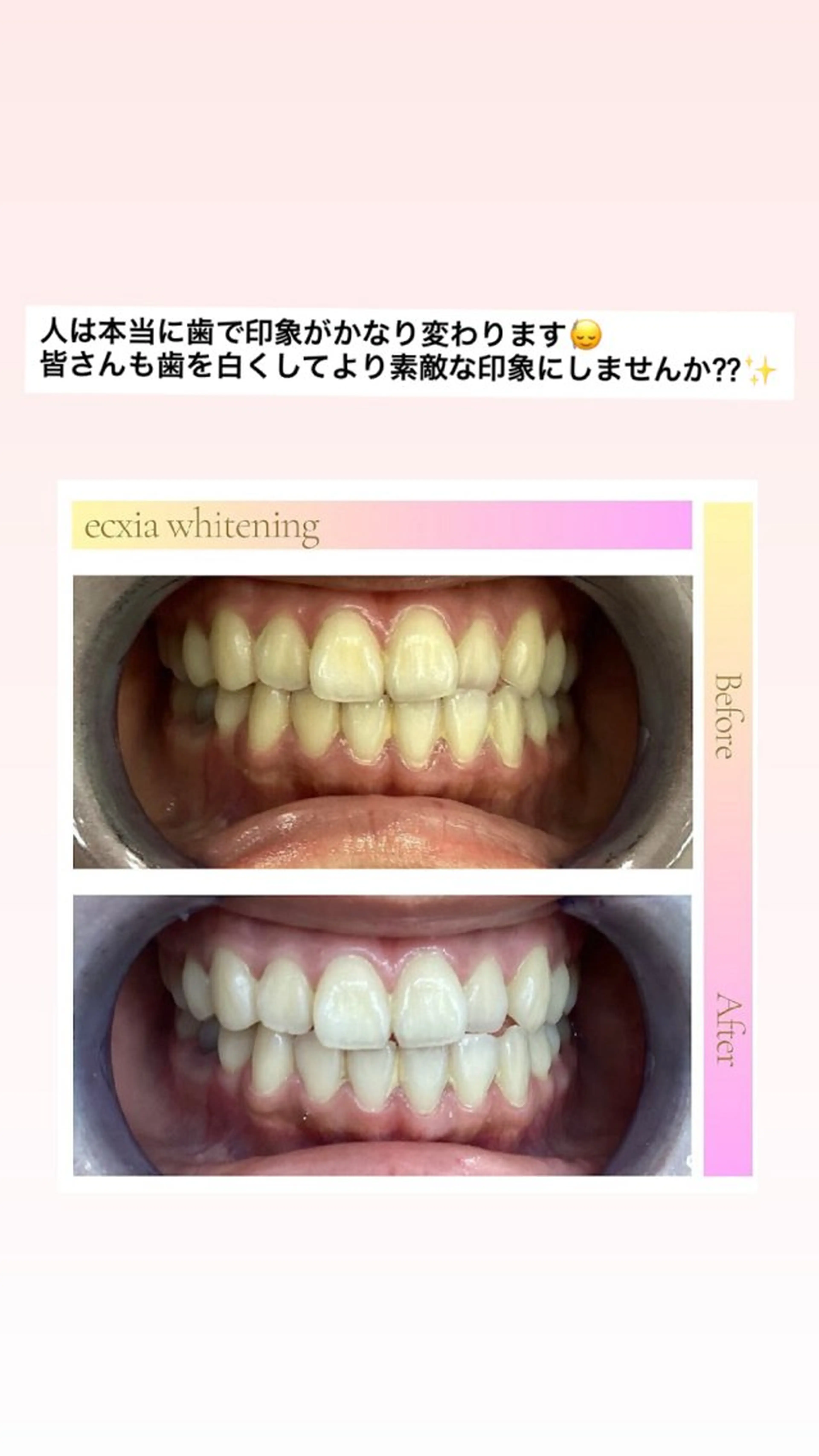 その他 エクシアホワイトニング草津店所属・nanami -ホワイトニングのその他イメージ