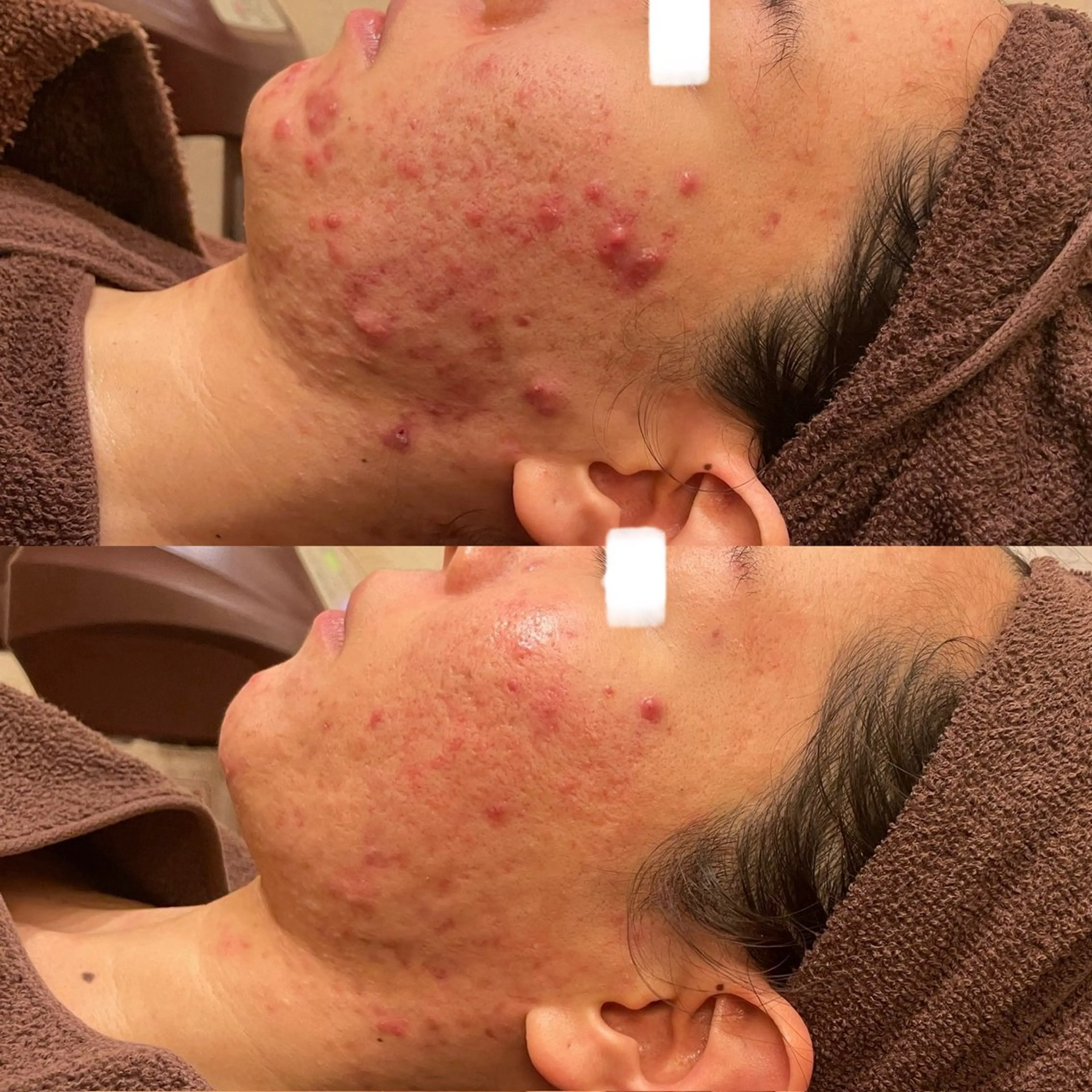 【ニキビ&シミ】スポンジア微細針＋生プラセンタフェイシャル33,000→16,500の写真