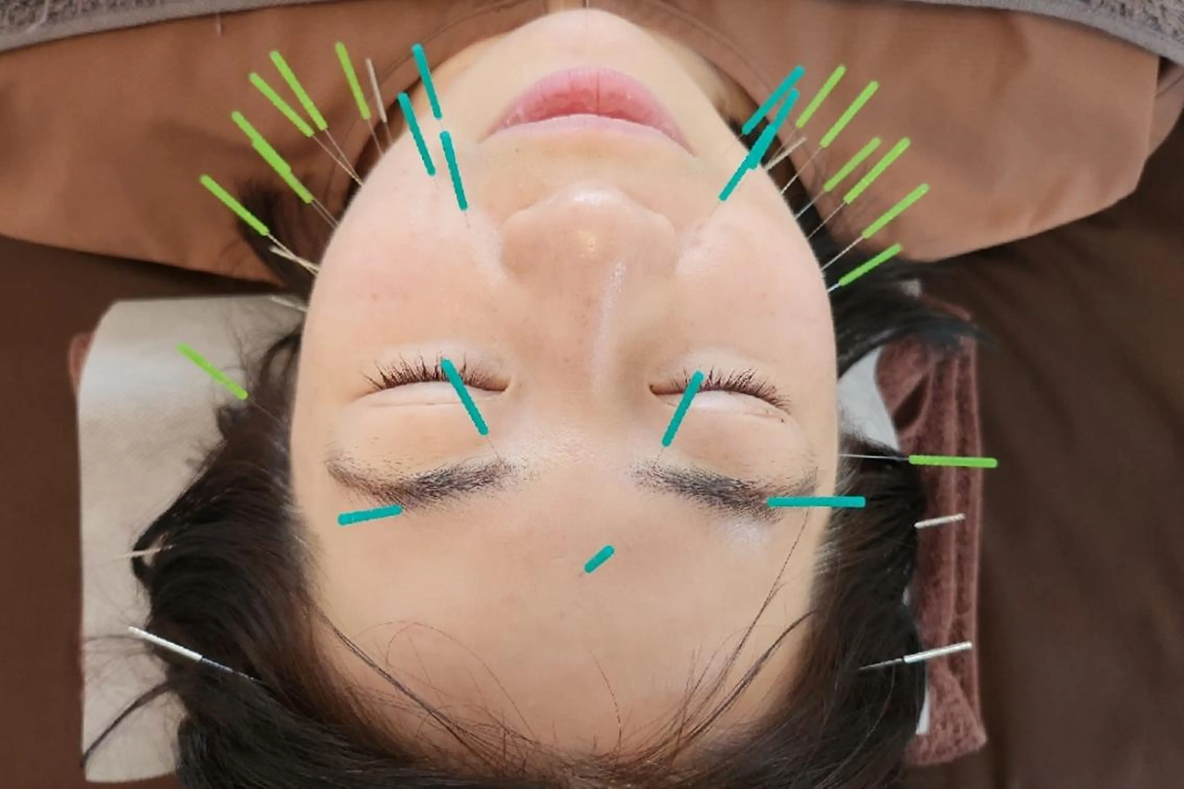 即効⚡小顔美容鍼🪡 むくみたるみ脂肪解消のエステ・リラクイメージ