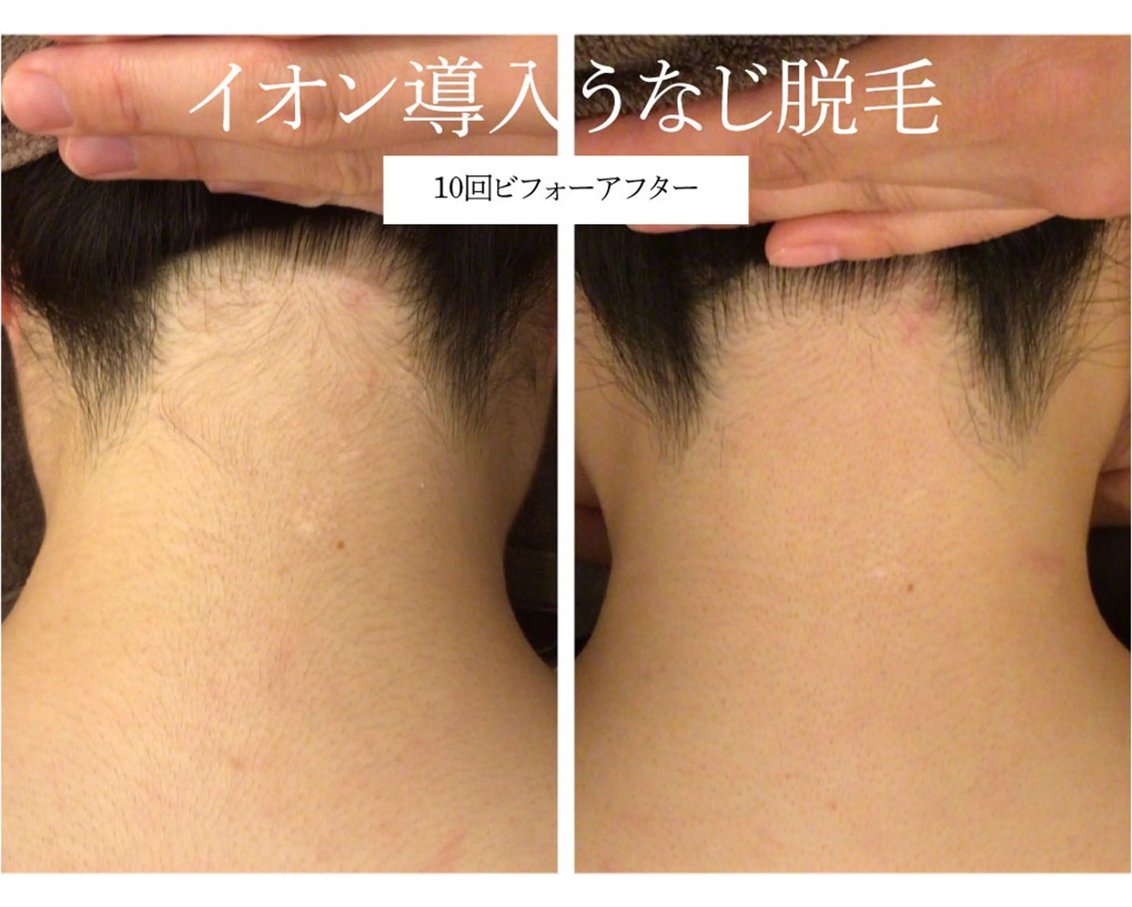 脱毛 Beauty  salon Lino所属・🎀うなじ脱毛🎀 ㅣLino堀江のエステ・リラクイメージ