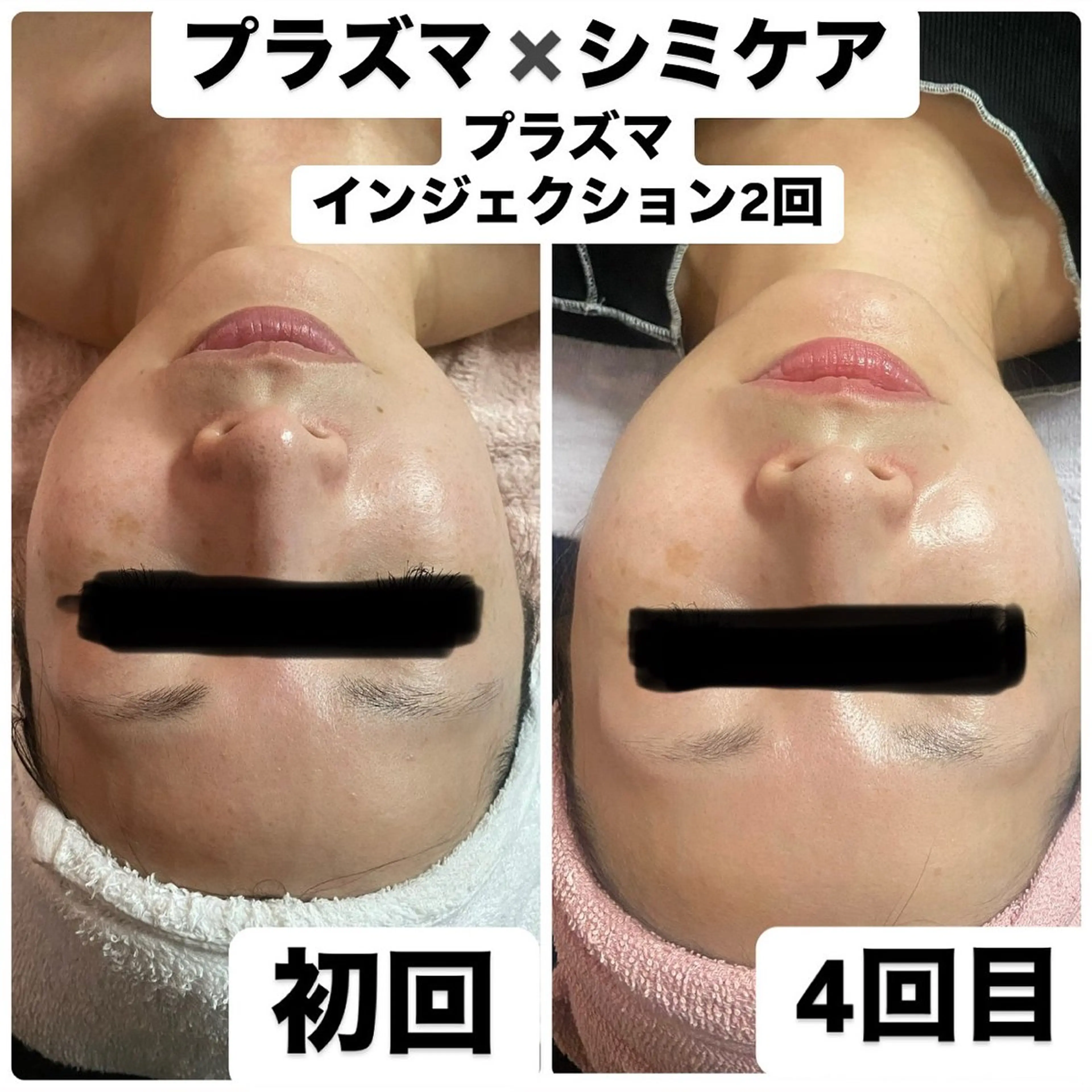 プラズマ✕炭酸W導入シミ・くすみ徹底ケア【シミケア10分】の写真