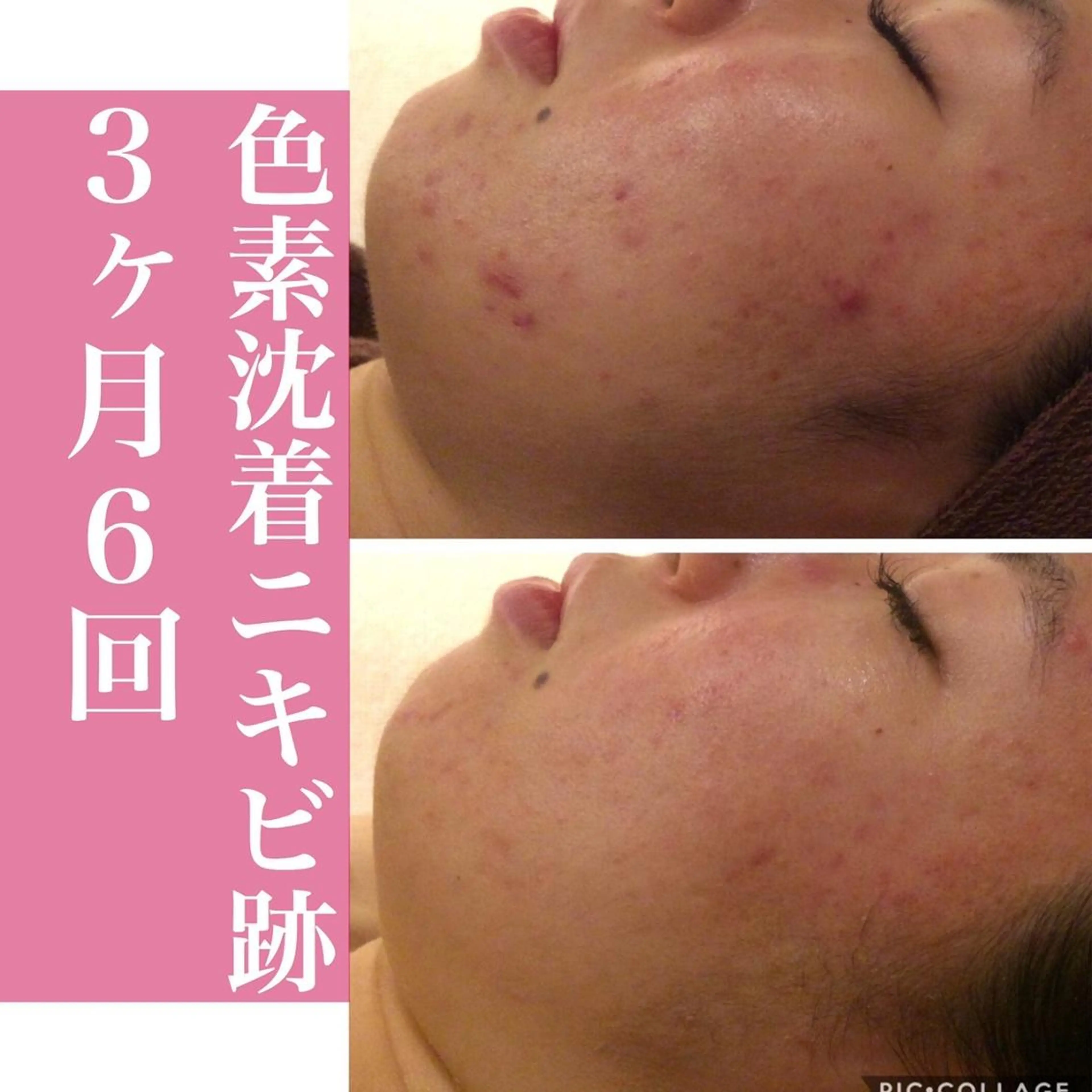 ニキビ特化型エステ 🍓最短で肌質改善のエステ・リラクイメージ