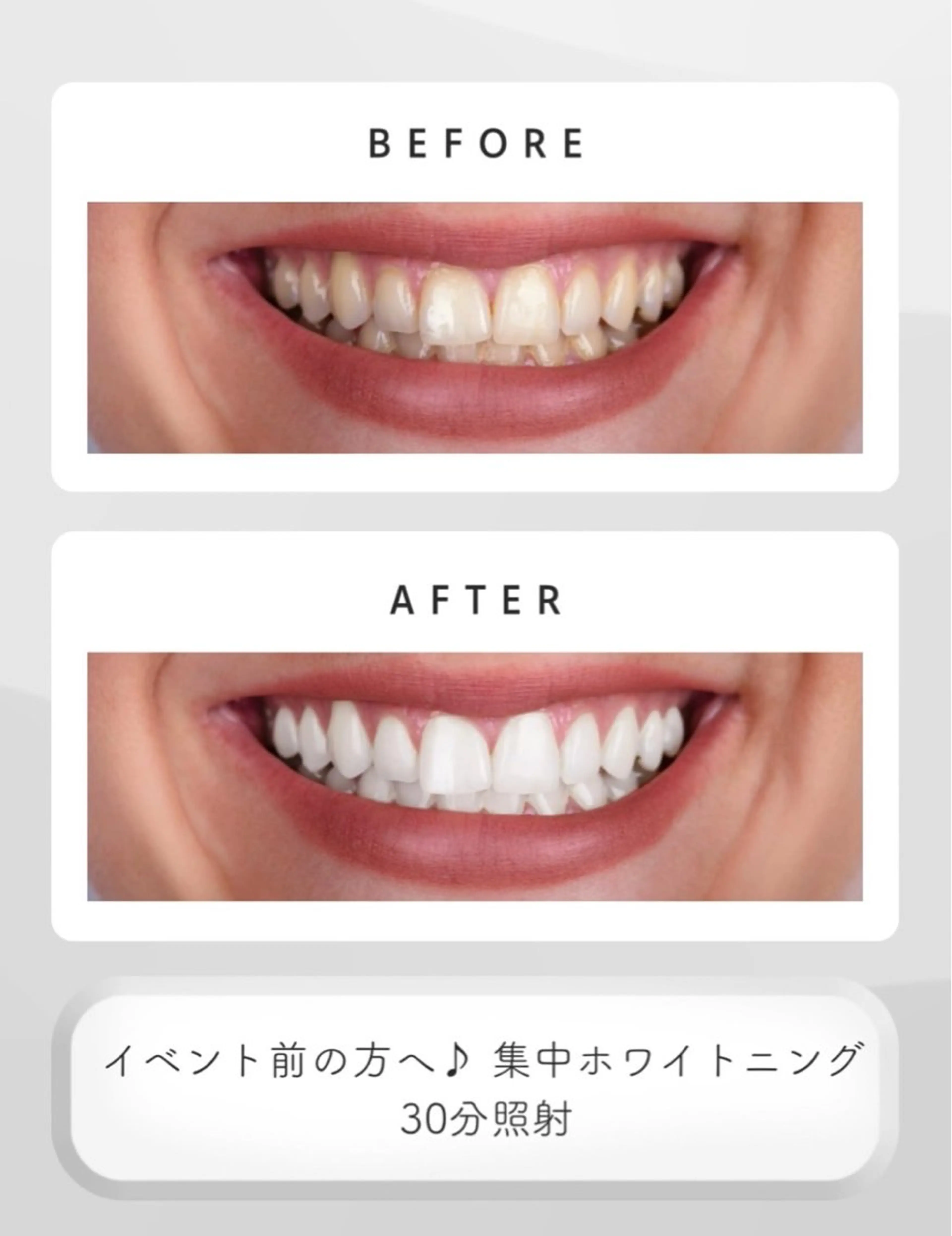 【イベント前の方】集中ホワイトニング30分照射🤍の写真