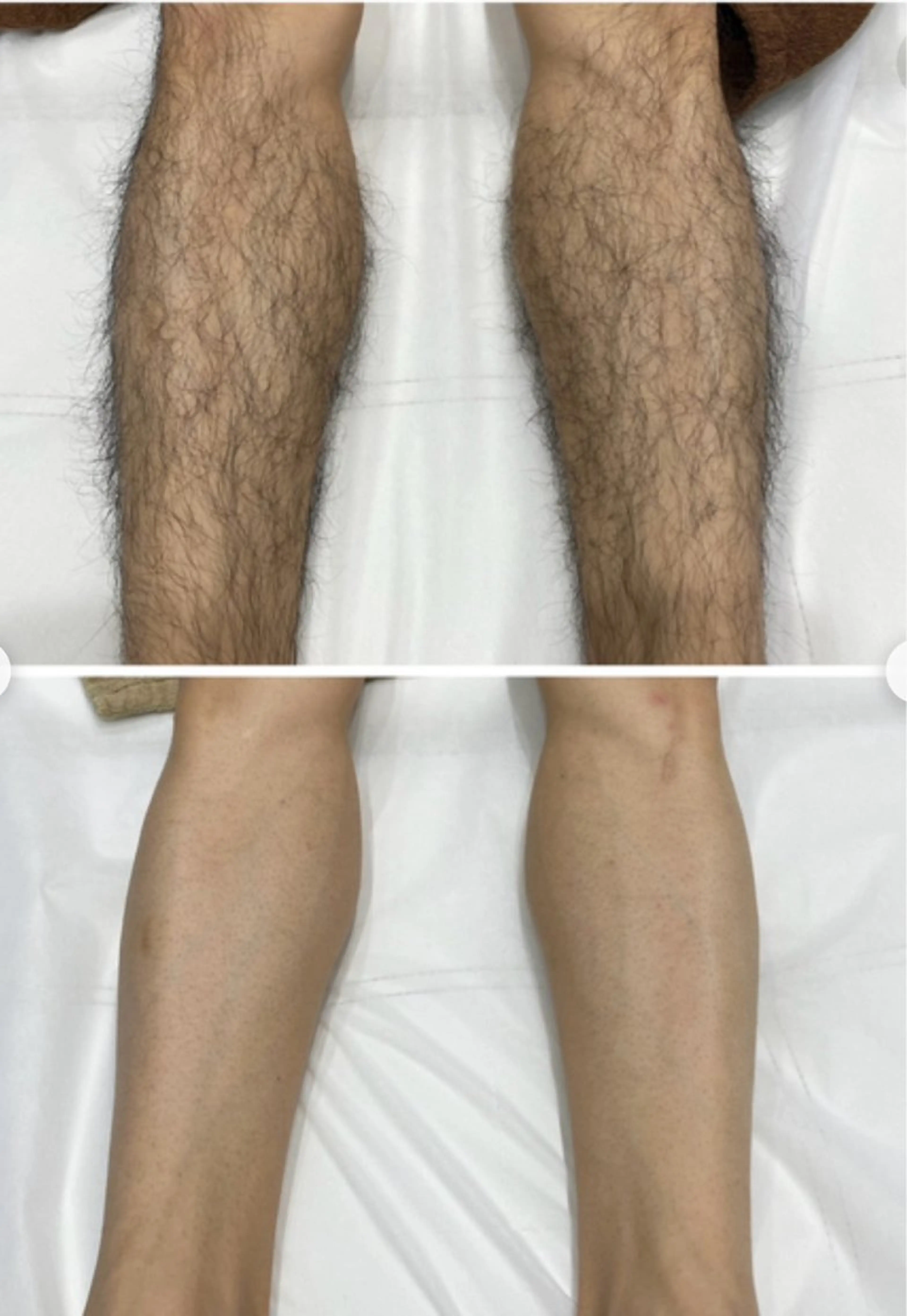 メンズ脱毛　足全体脱毛の写真