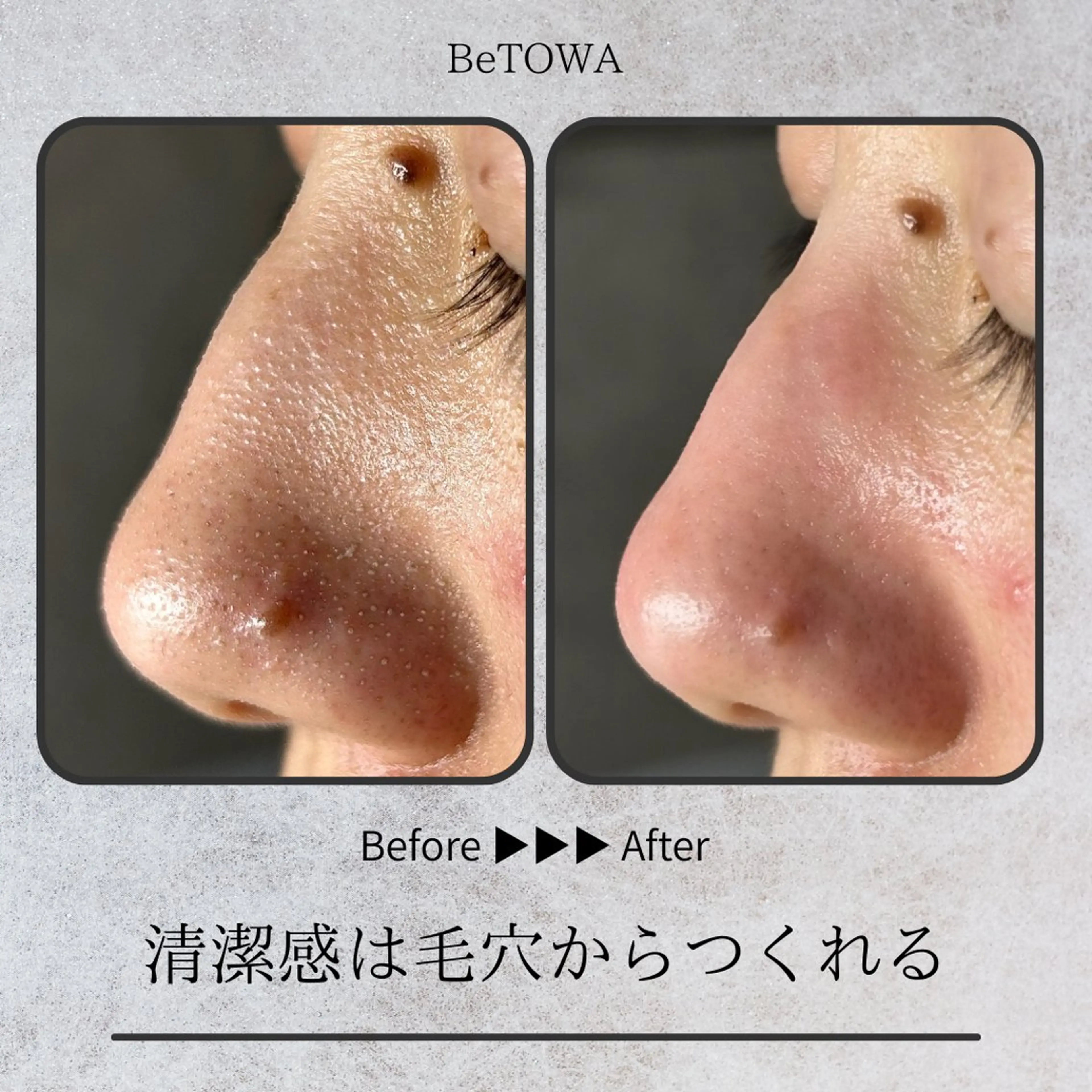 エステ BeTOWA所属・BeTOWA 毛穴洗浄／Wax脱毛のエステ・リラクイメージ