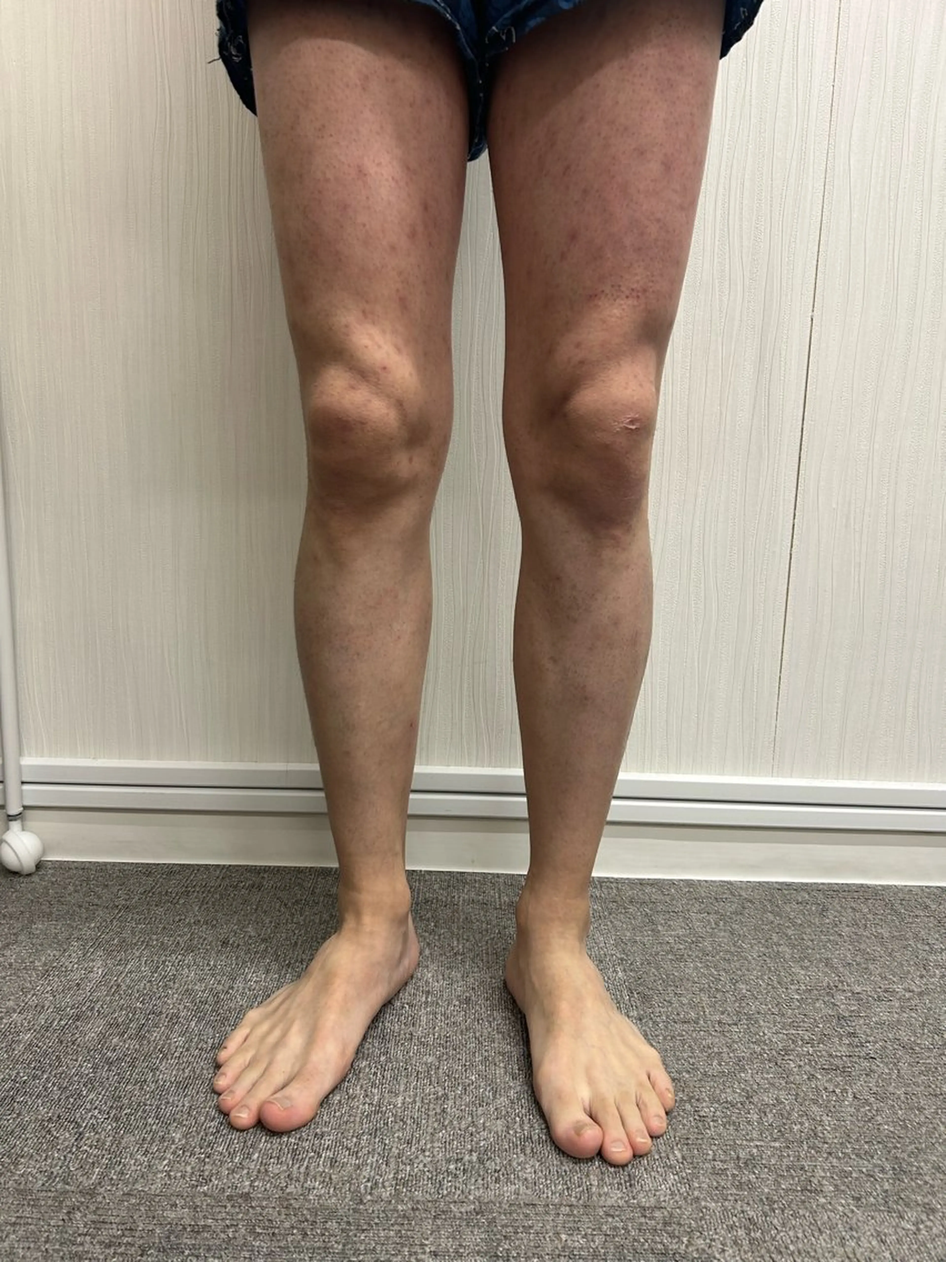 男性足まるごと脱毛メンズの写真