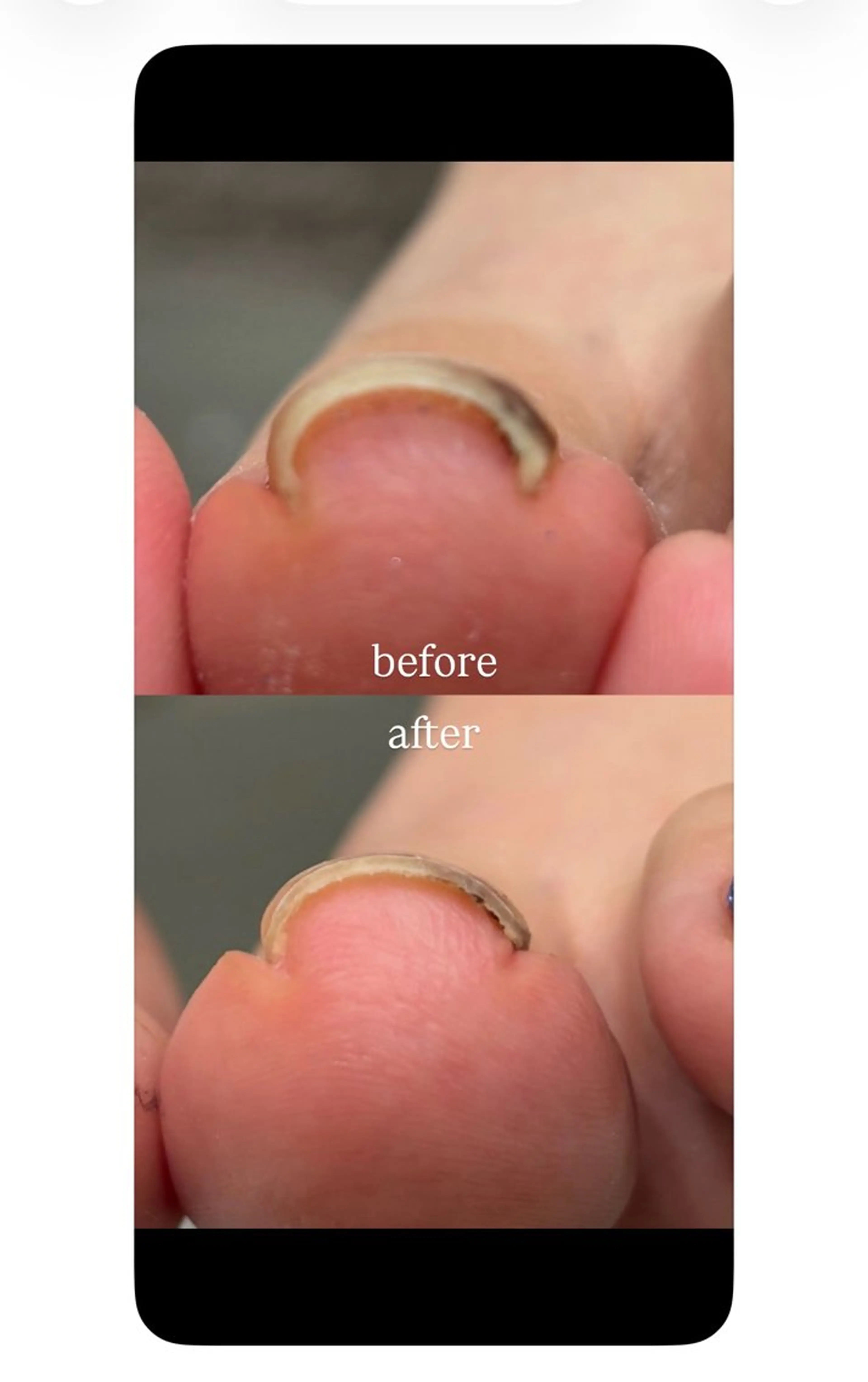 10名限定！【牽引機➕プレート】巻き爪ケアの写真