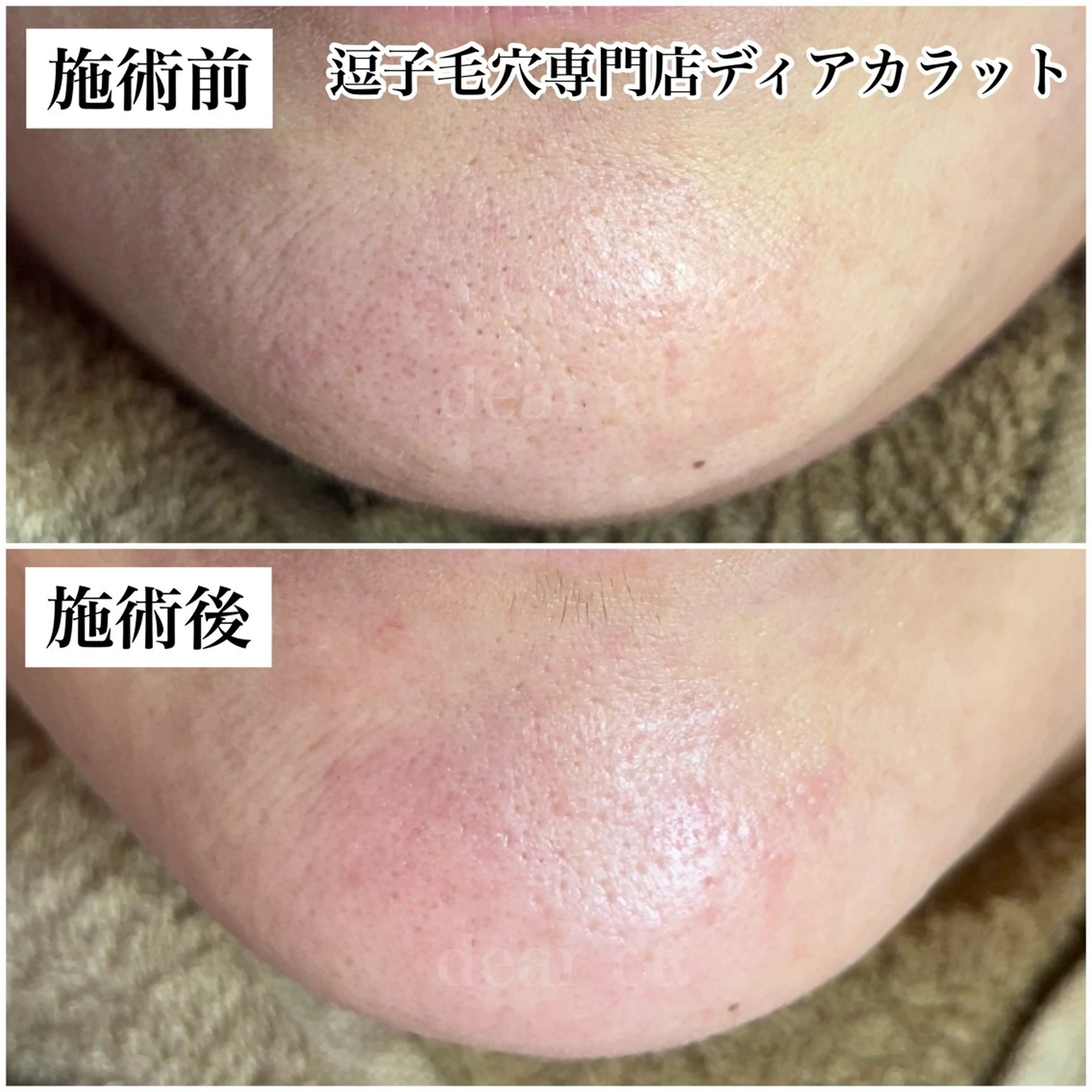 エステ リラク 毛穴専門店　dear Ct.所属・毛穴専門店 ディアカラットのエステ・リラクイメージ