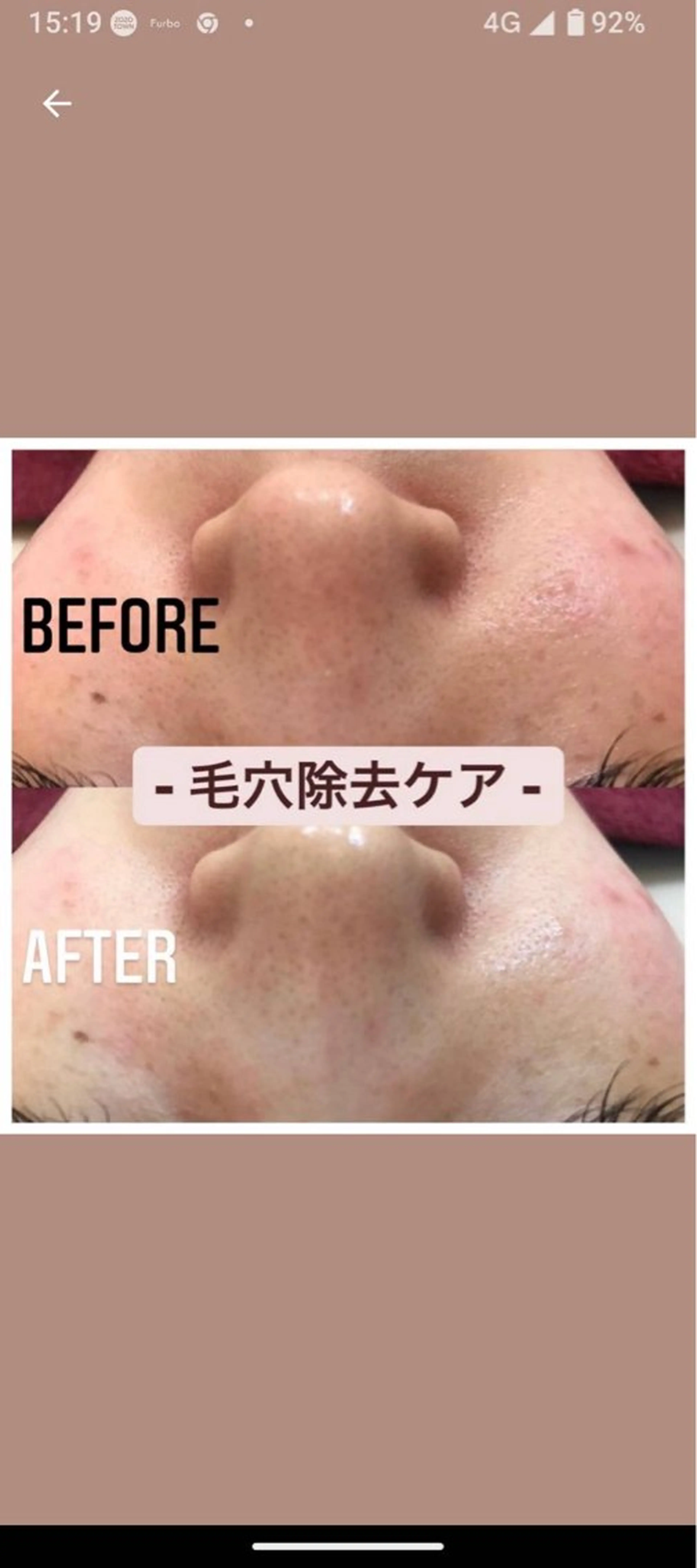 ✨️20才​〜​27才の女性限定👸毛穴ケア🌈乾燥肌‼️ニキビ肌‼️の方にもオススメ✨️毛穴/美白/黒ずみ/ピーリングの写真