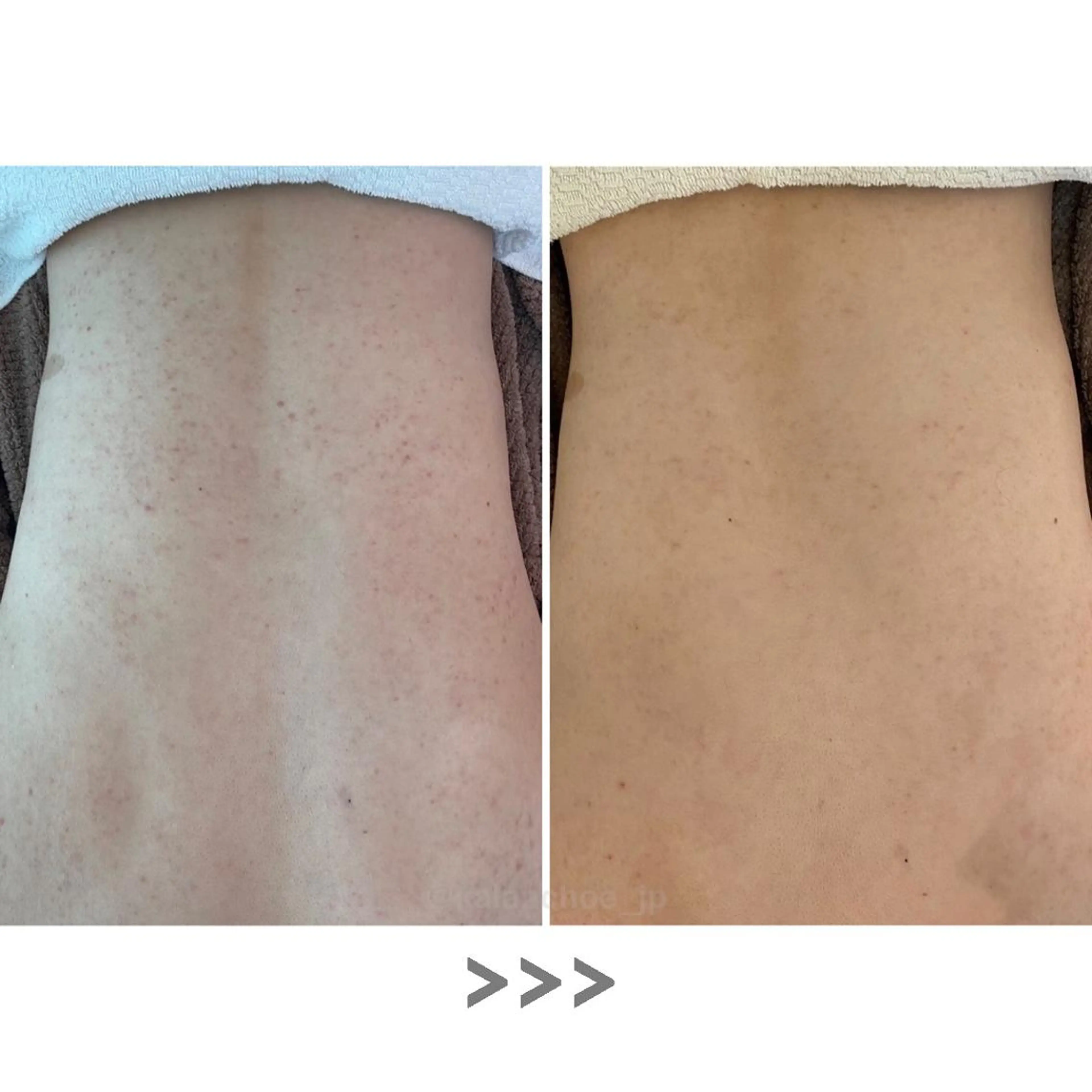 エステ リラク 肌質改善 KALANCHOEのエステ・リラクイメージ