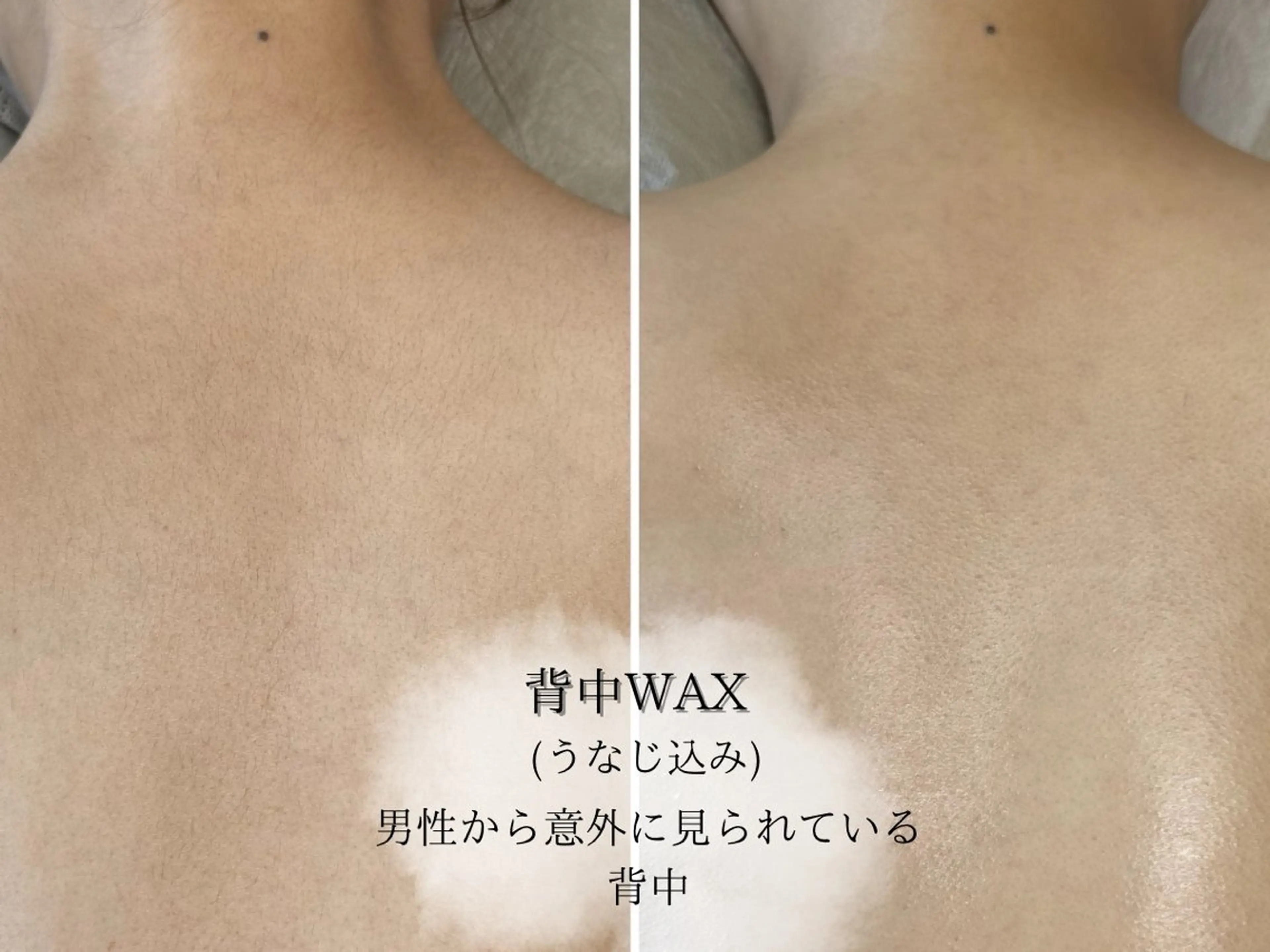 🩵minimoセール🩵【 背中全体ワックス脱毛(うなじ･背中･腰)🎀 】の写真