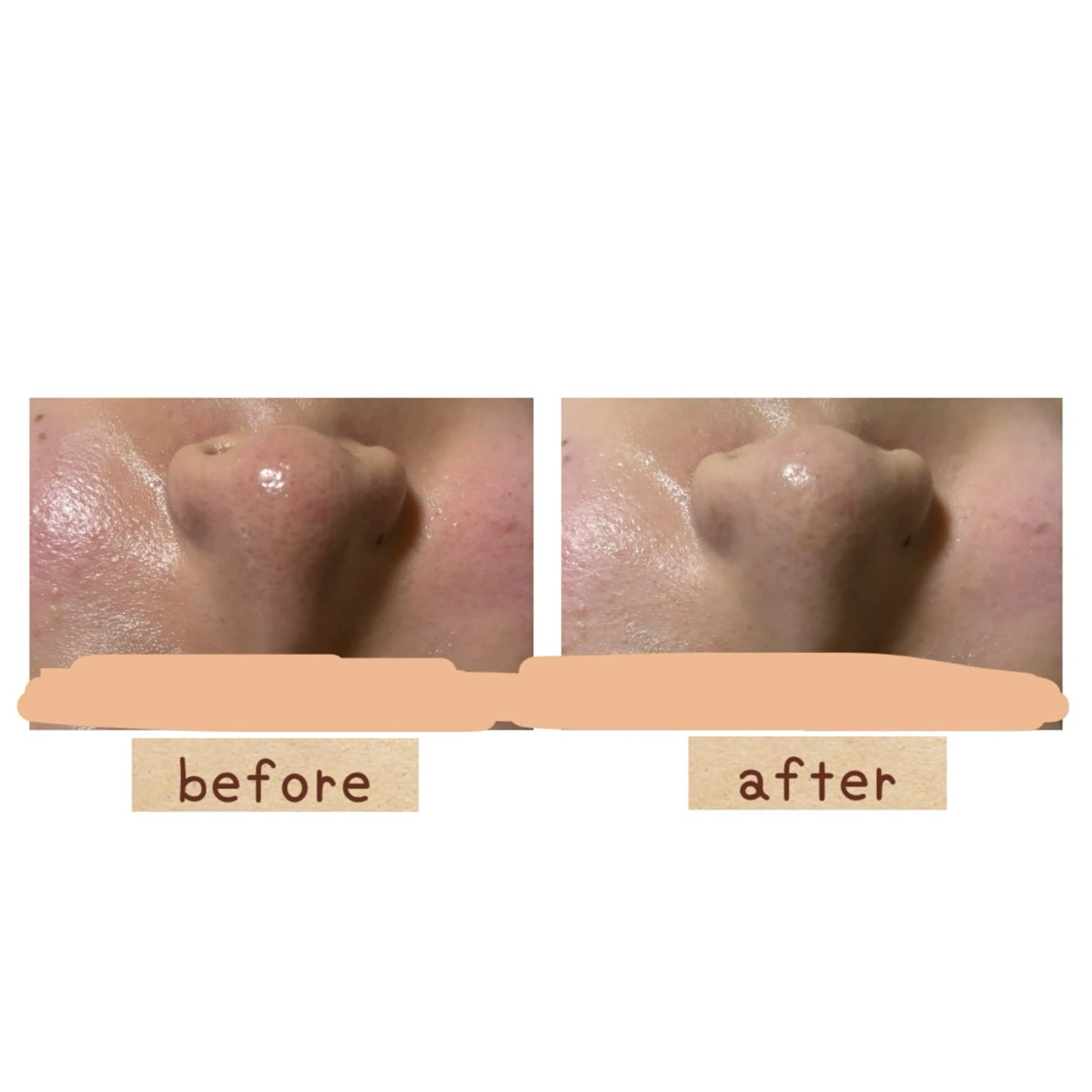 エステ 【前橋市】毛穴洗浄× オールハンドリンパのエステ・リラクイメージ