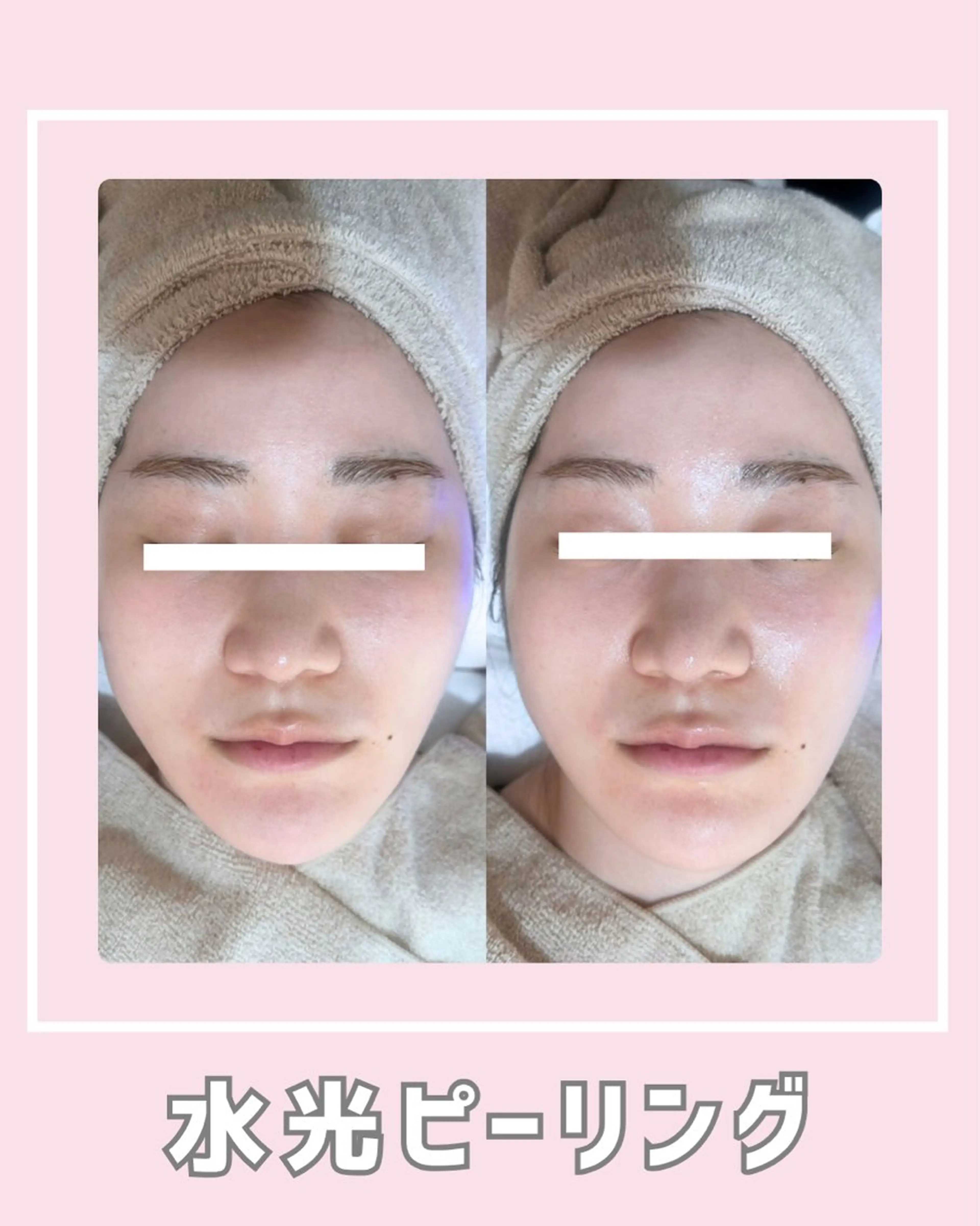 エステ |ピーリング・毛穴| soina神楽坂のエステ・リラクイメージ