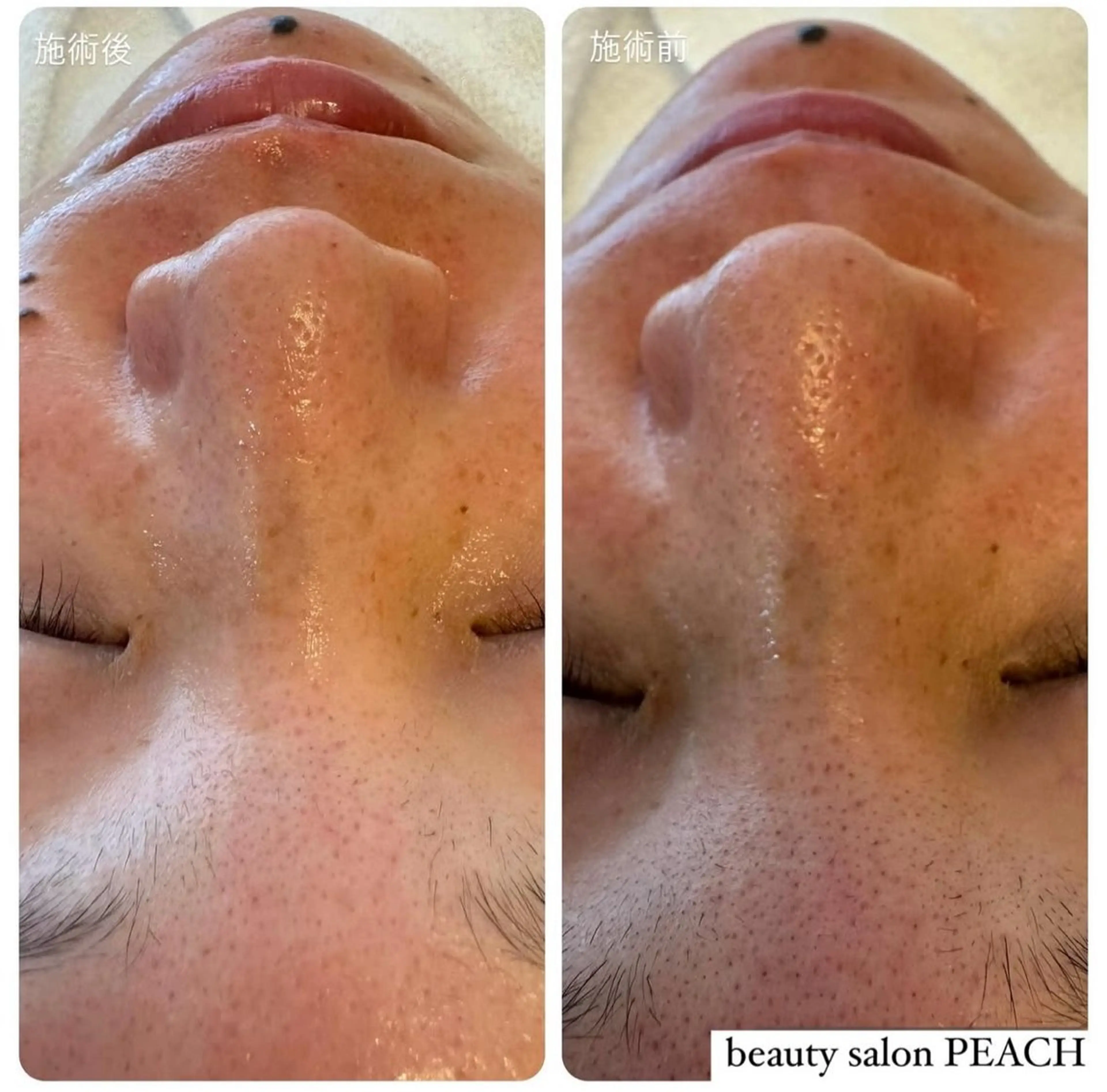 【ツルツル感動】バイオウォーミーパック➕毛穴侍の写真