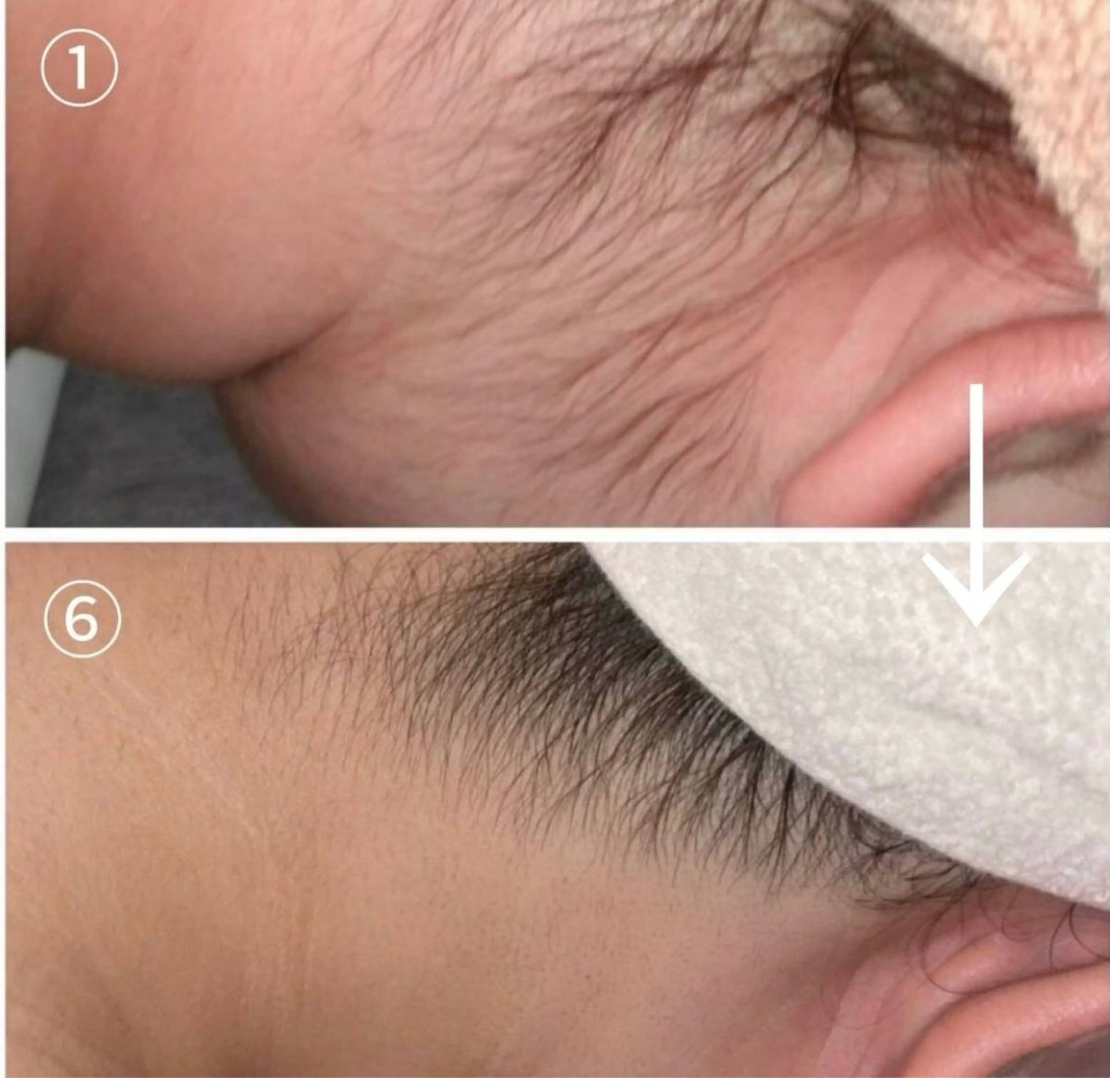 【モニター募集】うなじ脱毛（0円）の写真