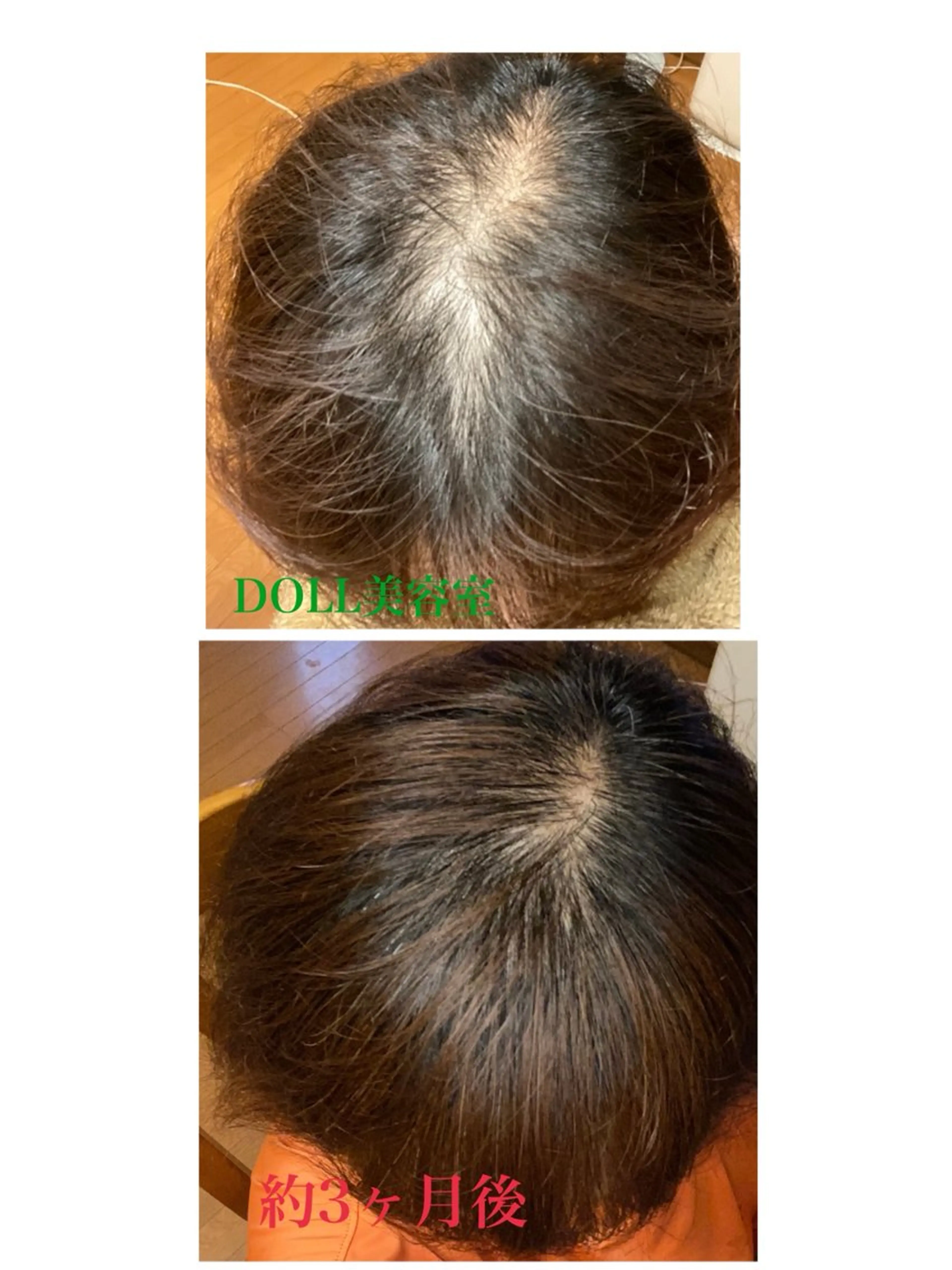 女性のための育毛カウンセリングコースの写真