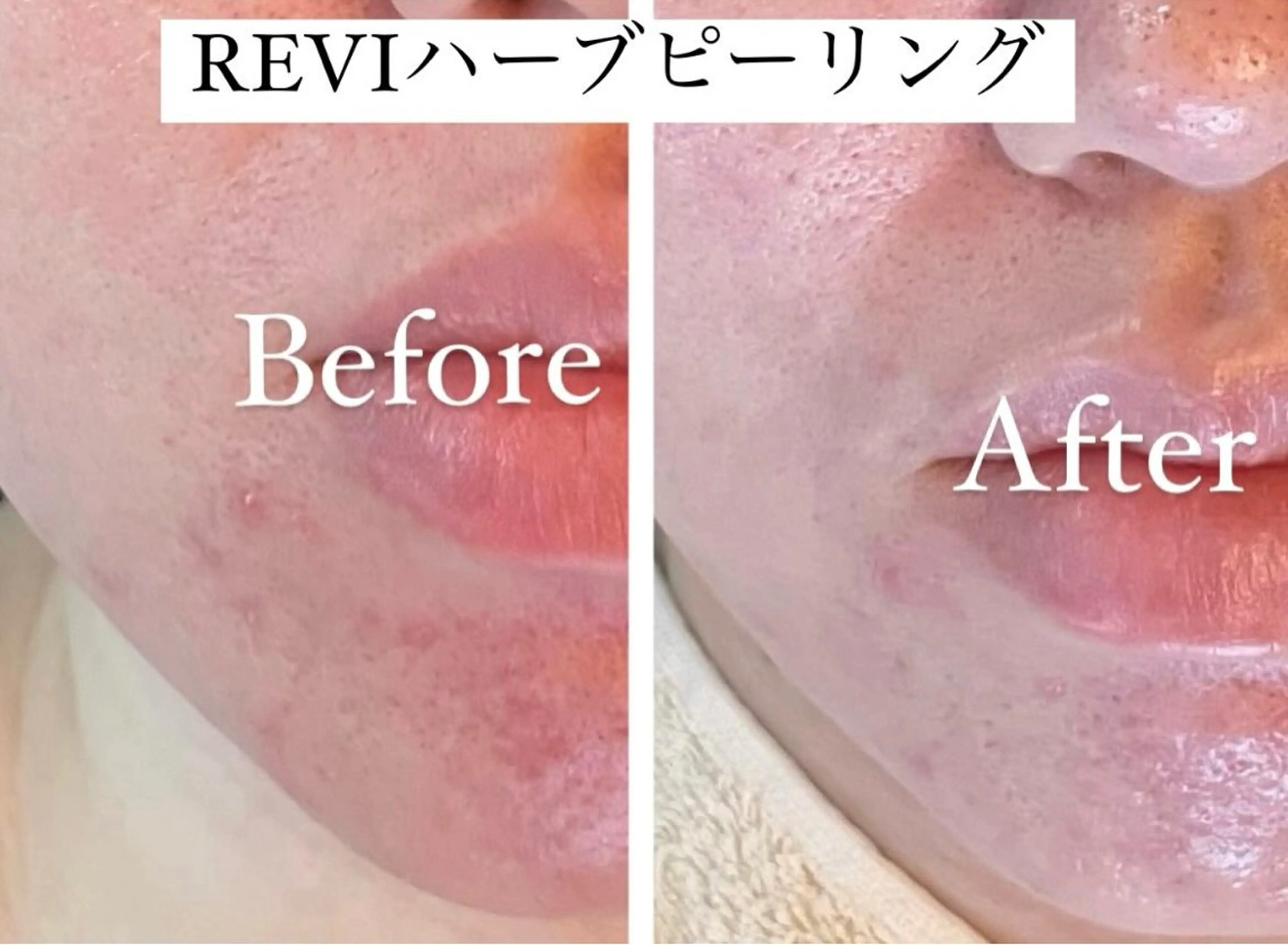 エステ 🌿ハーブピーリング ・脱毛◆Refreのエステ・リラクイメージ