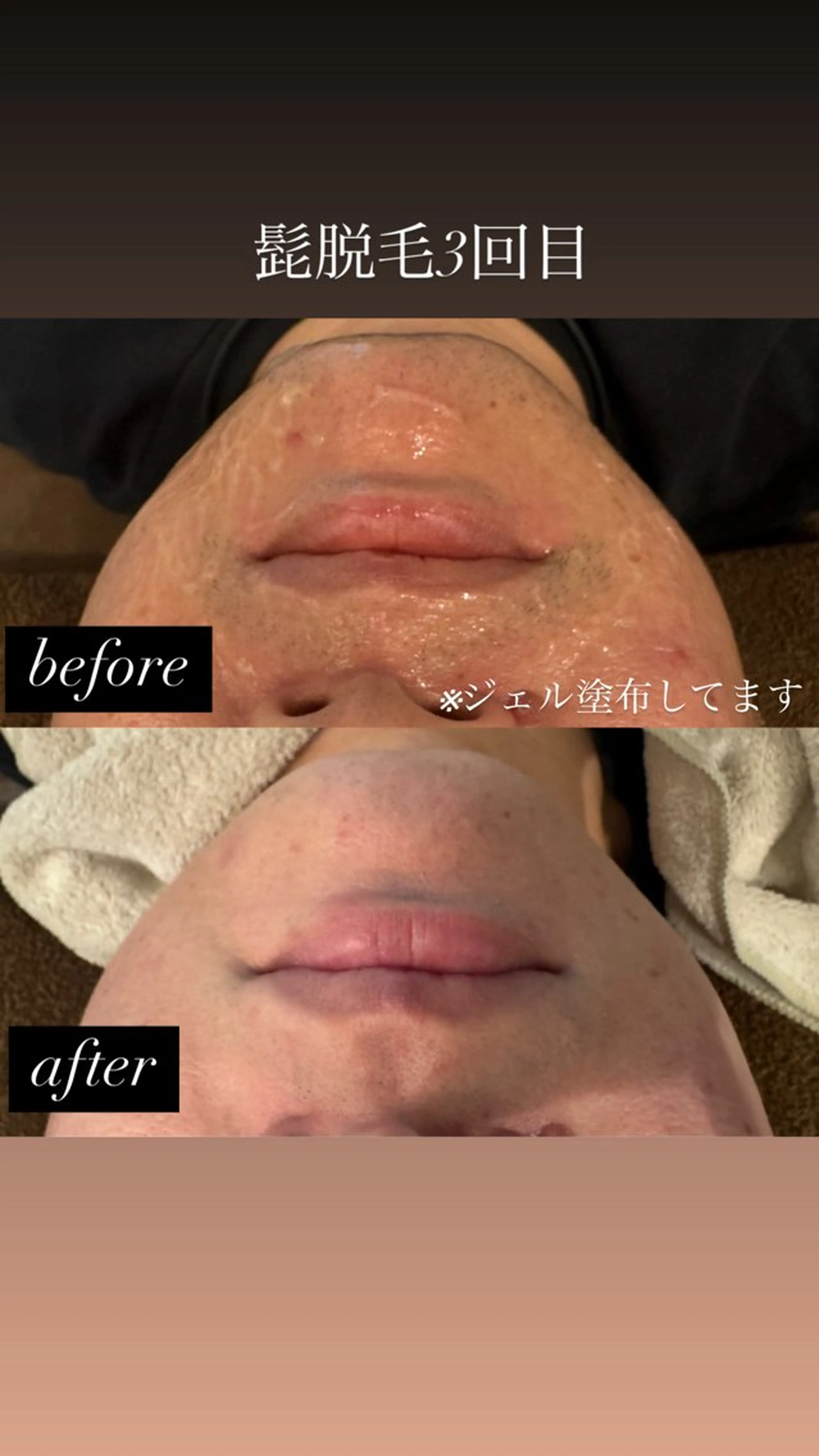 メンズ 脱毛 Micell beauty所属・Micell beautyのエステ・リラクイメージ