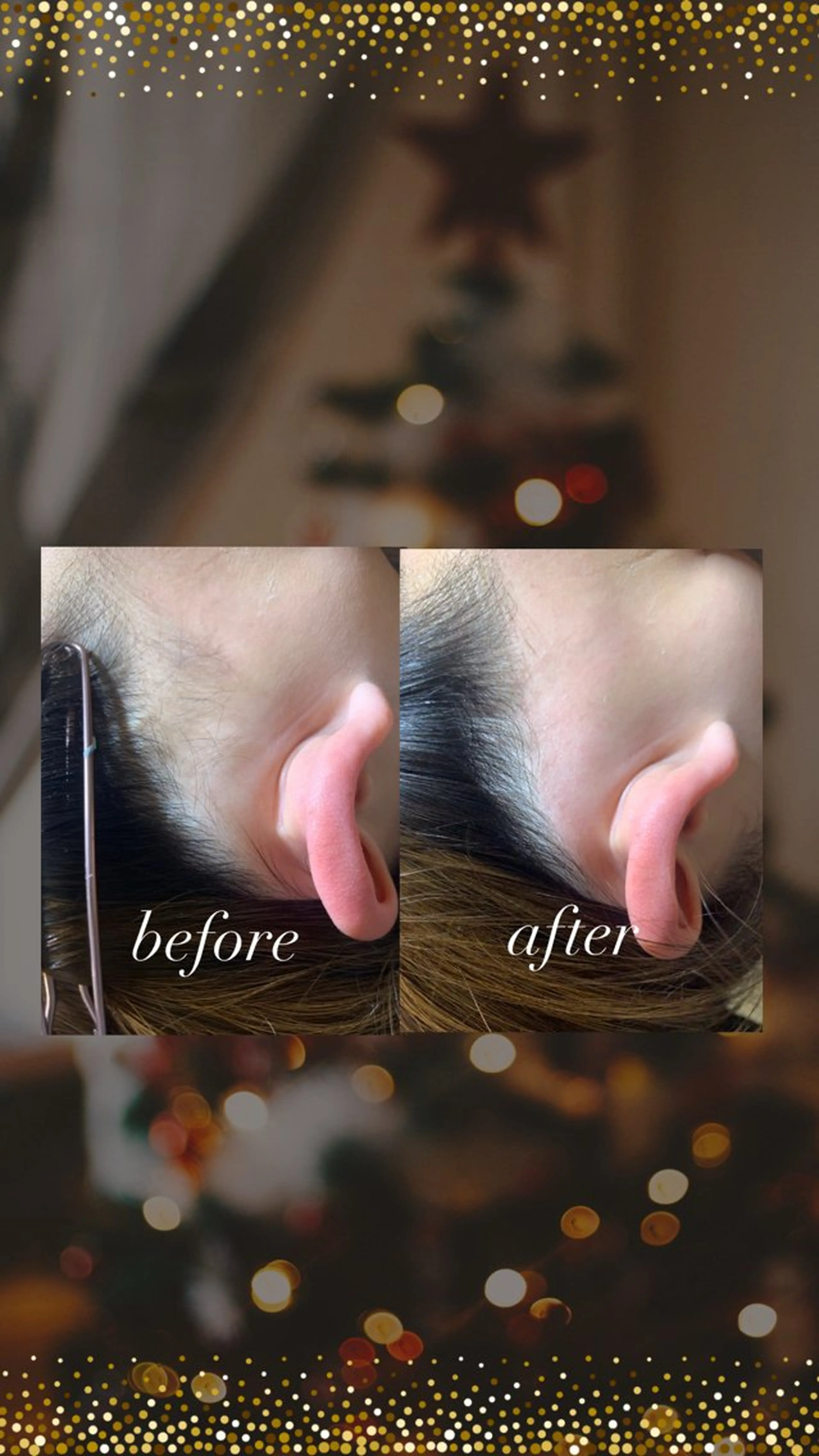 【後ろ姿美人✨】スッキリ綺麗に！うなじ、もみあげWax脱毛（＋保湿付）の写真