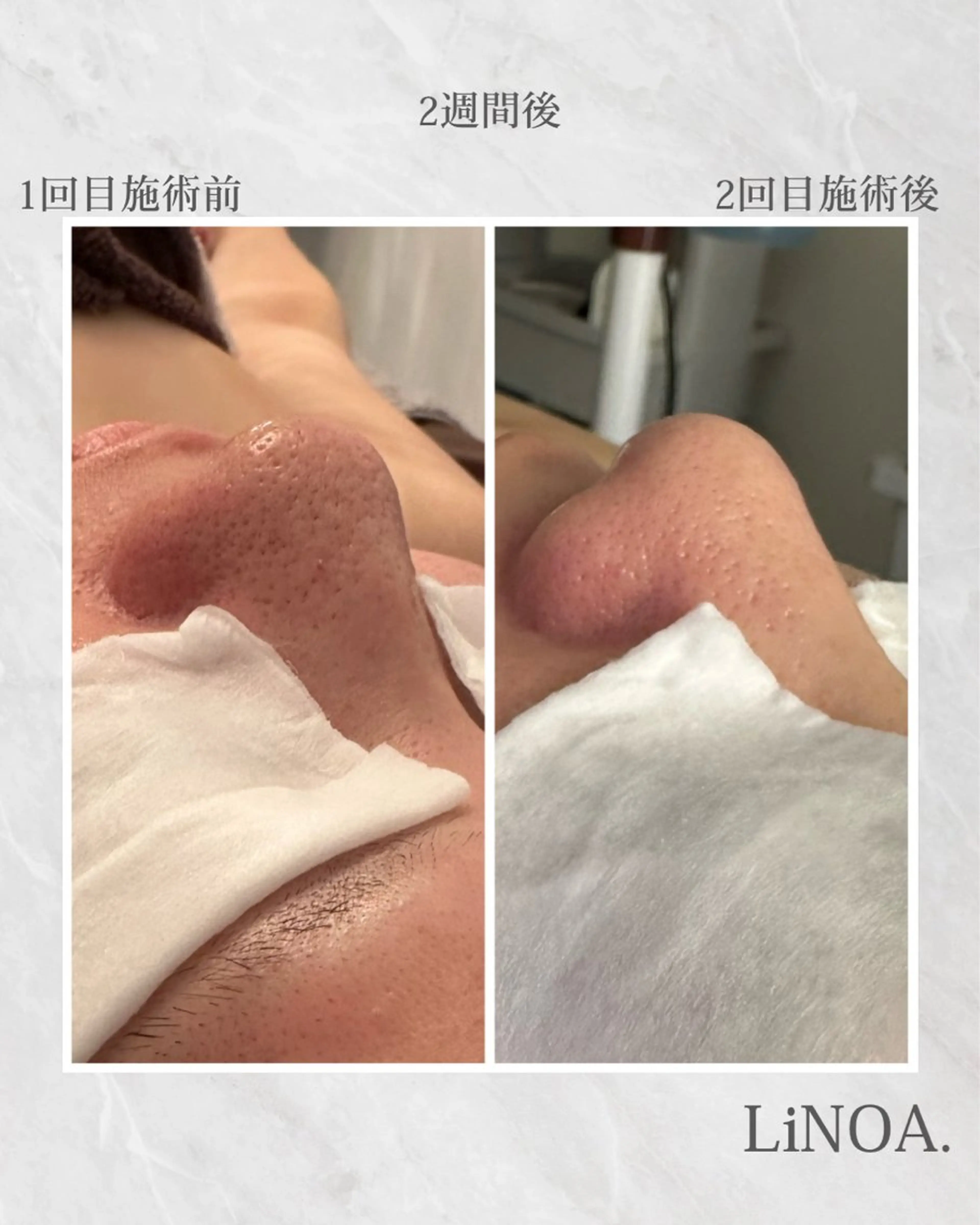 毛穴レス・美肌深層ハリ肌集中ケアの写真