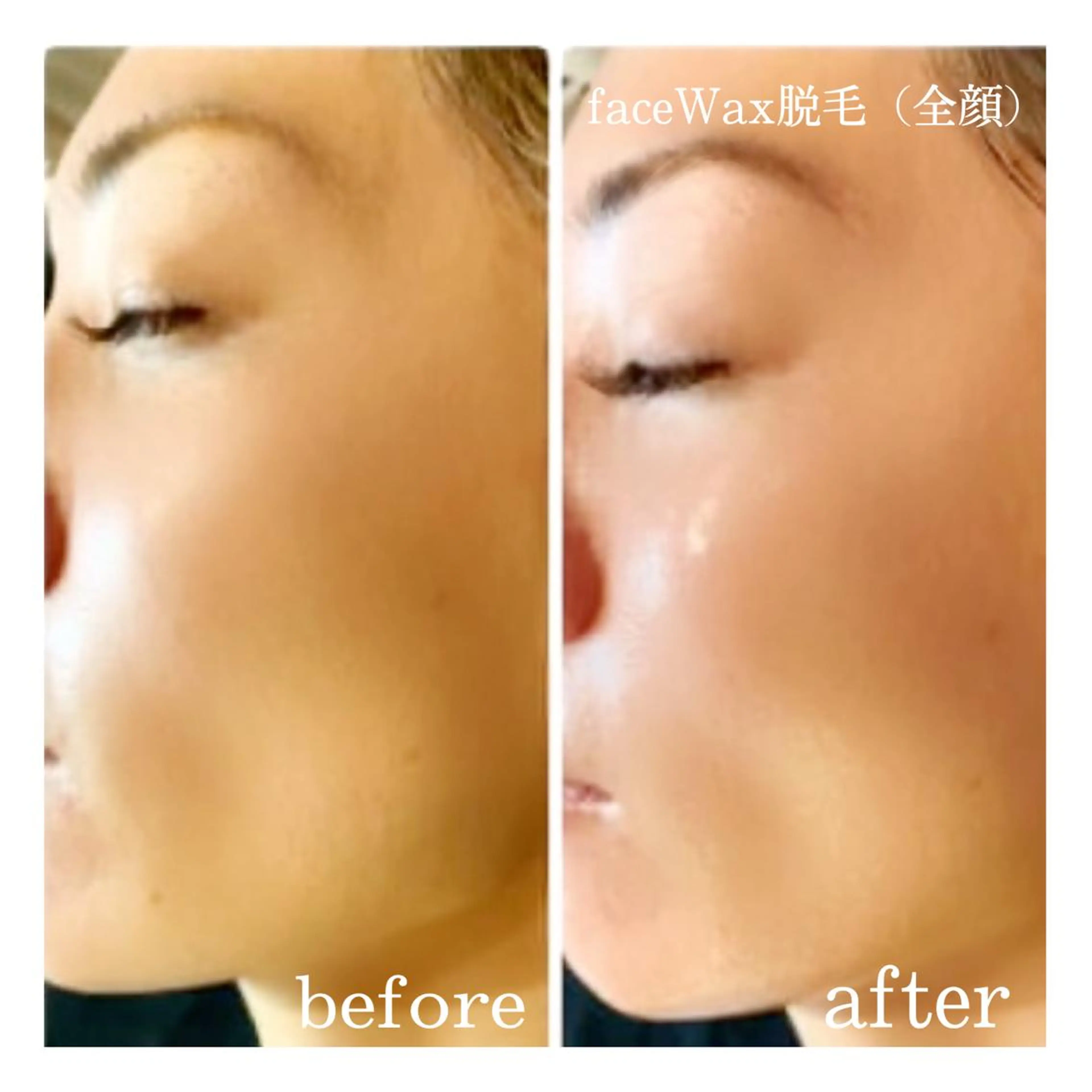 フェイスWax脱毛　額・頬・鼻・鼻下・口周り・眉周りを Waxでムダ毛や古い角質、皮脂汚れを除去☆ 1度でつやつや肌に✨の写真