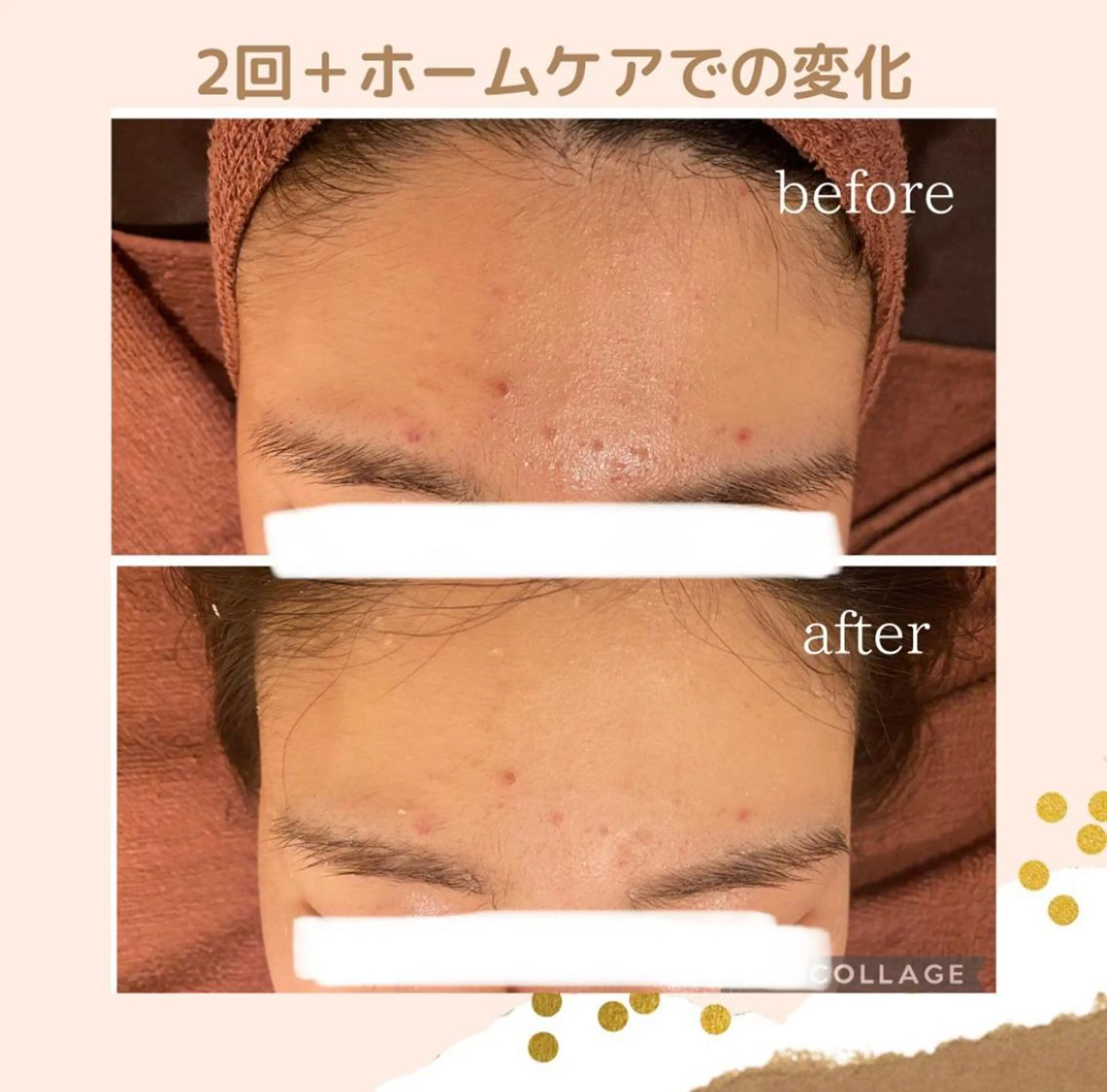 夏までに肌荒れ卒業 するサロン🌻のエステ・リラクイメージ