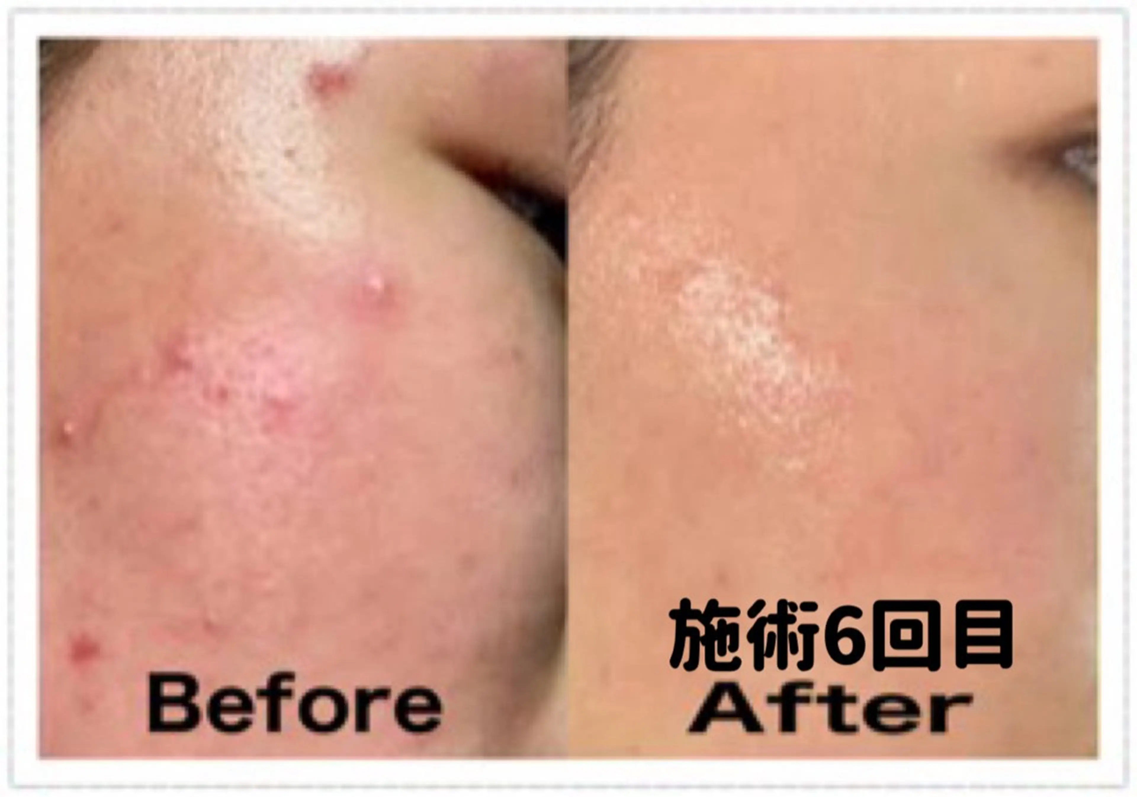 ミニモ学割/U24 特別価格【☆乾燥肌／敏感肌/ニキビ肌】毛穴洗浄他☆ 学生証提示(免許証など不可) 24歳以下限定！の写真