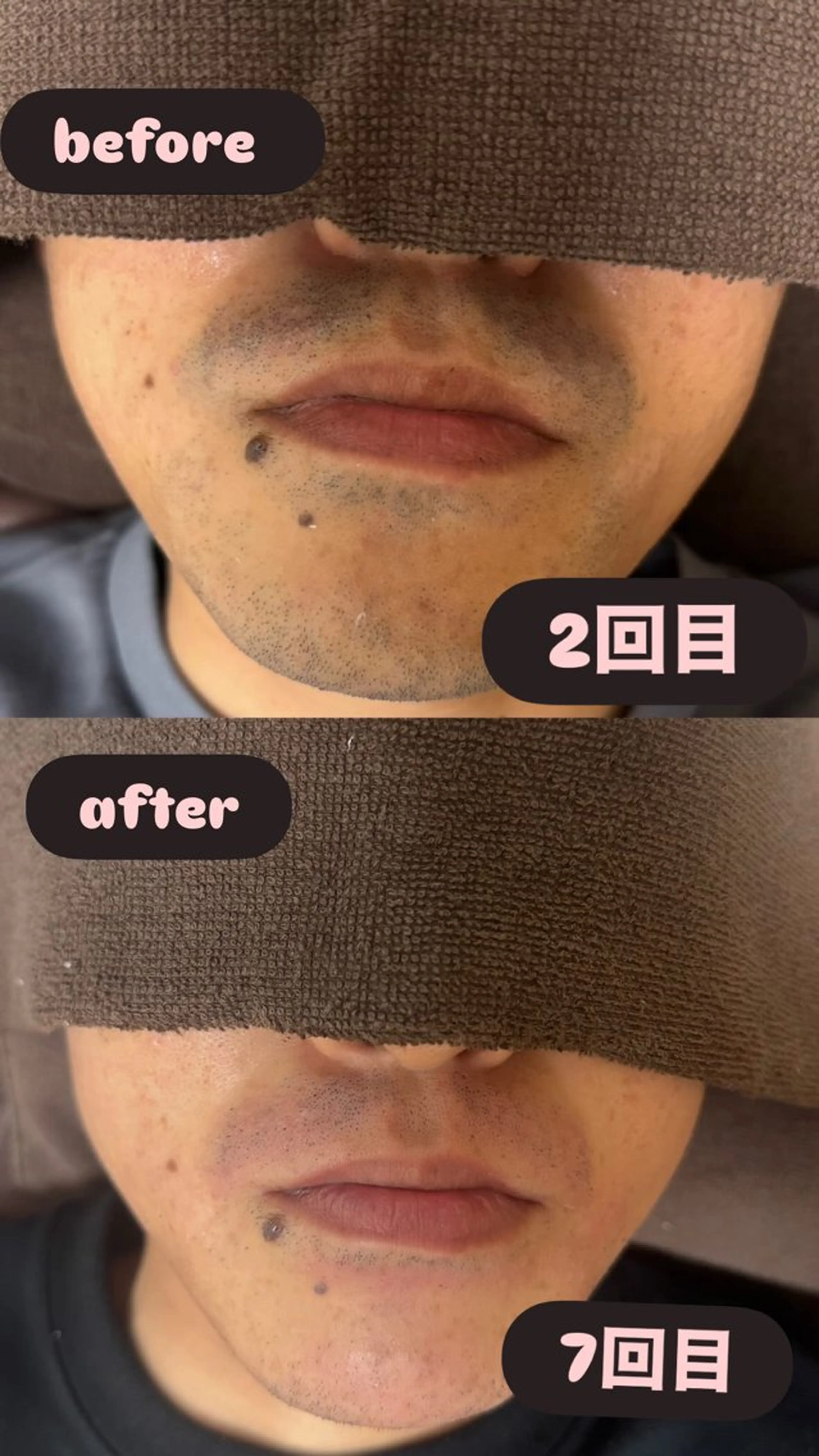 メンズ 脱毛 菊池 雪乃のエステ・リラクイメージ