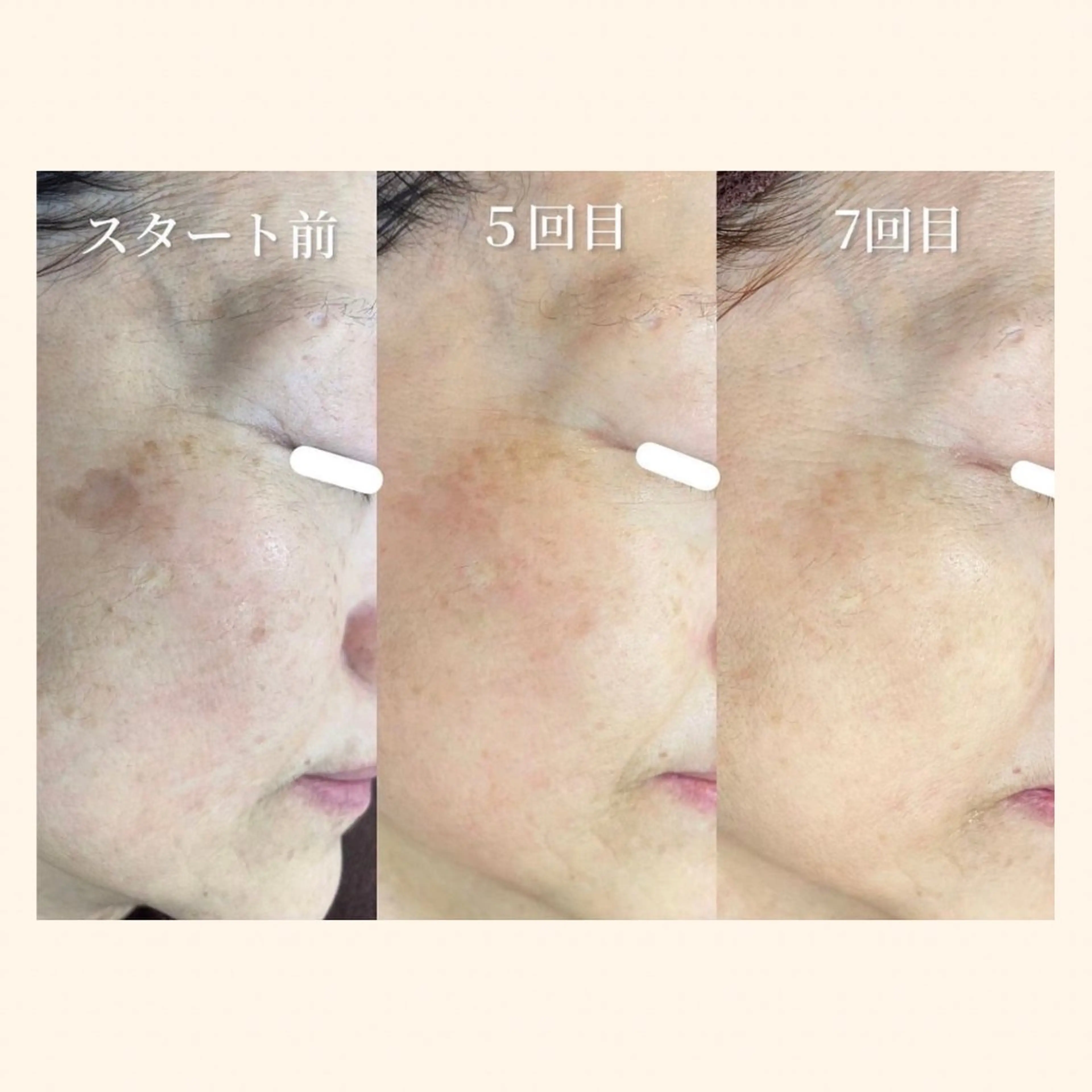 マツエク・マツパ その他 韓国肌管理 【毛穴専科】のエステ・リラクイメージ