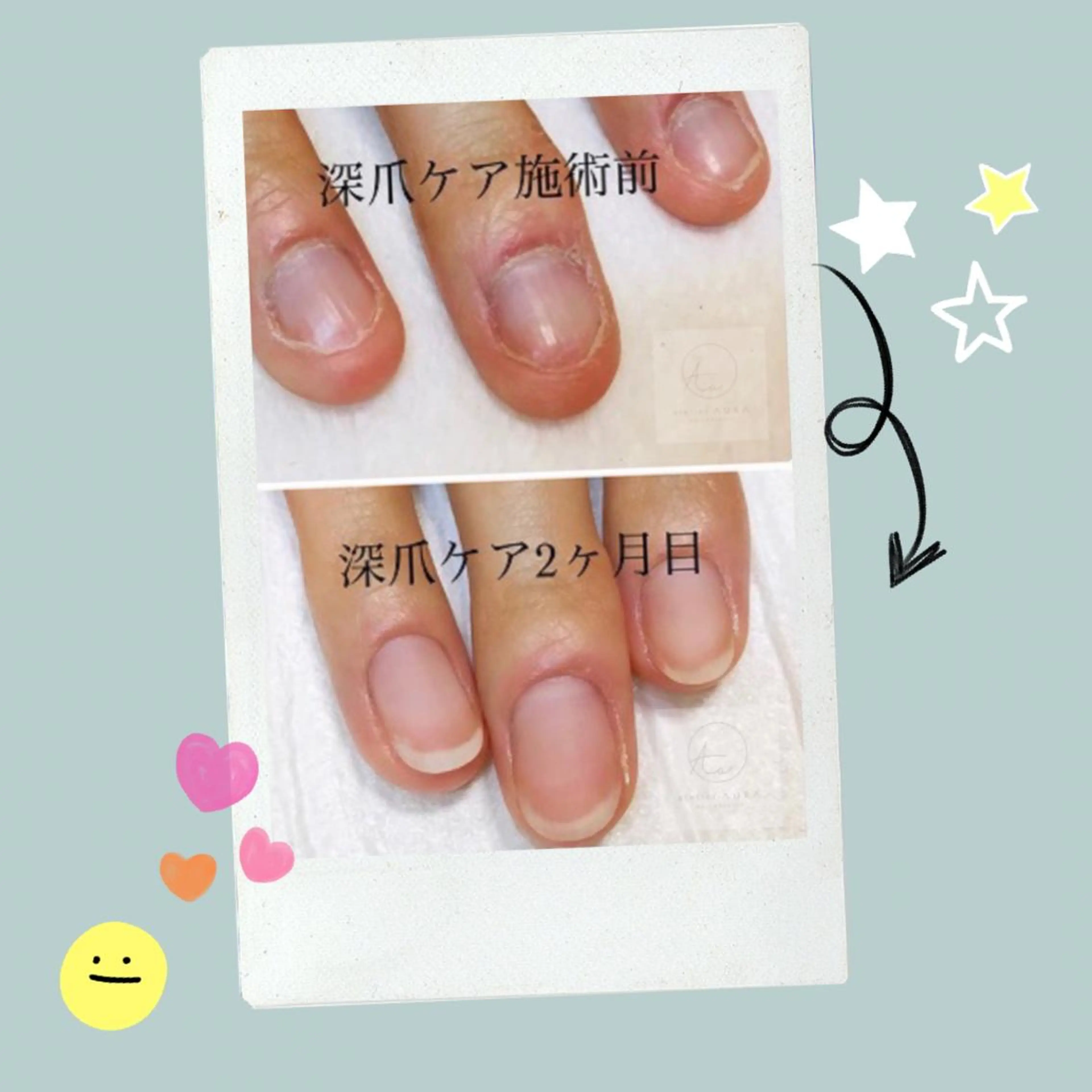 深爪矯正　自爪育成の写真