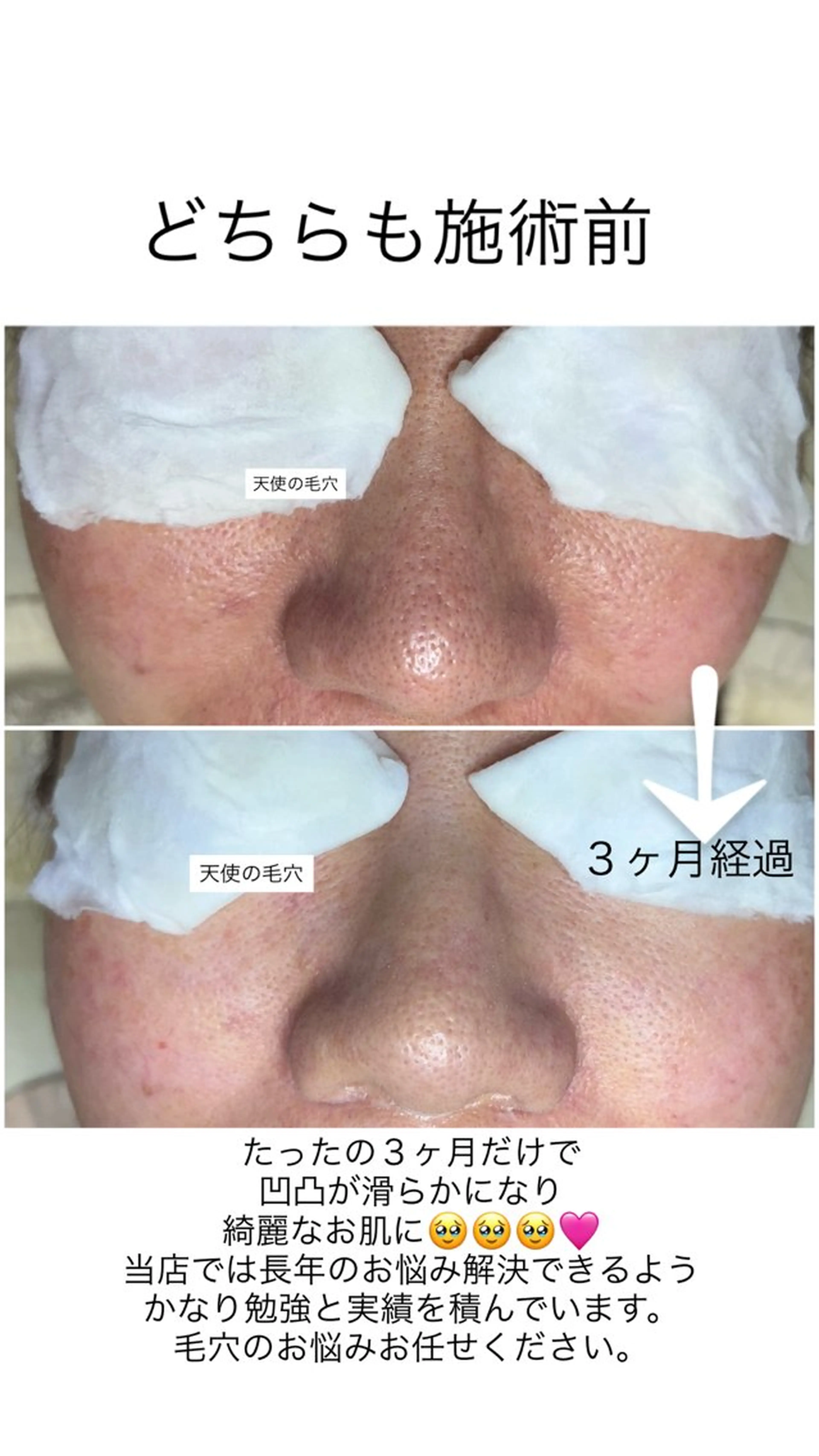 エステ 毛穴専門店RANA所属・毛穴専門店【各務原】 天使の毛穴のエステ・リラクイメージ