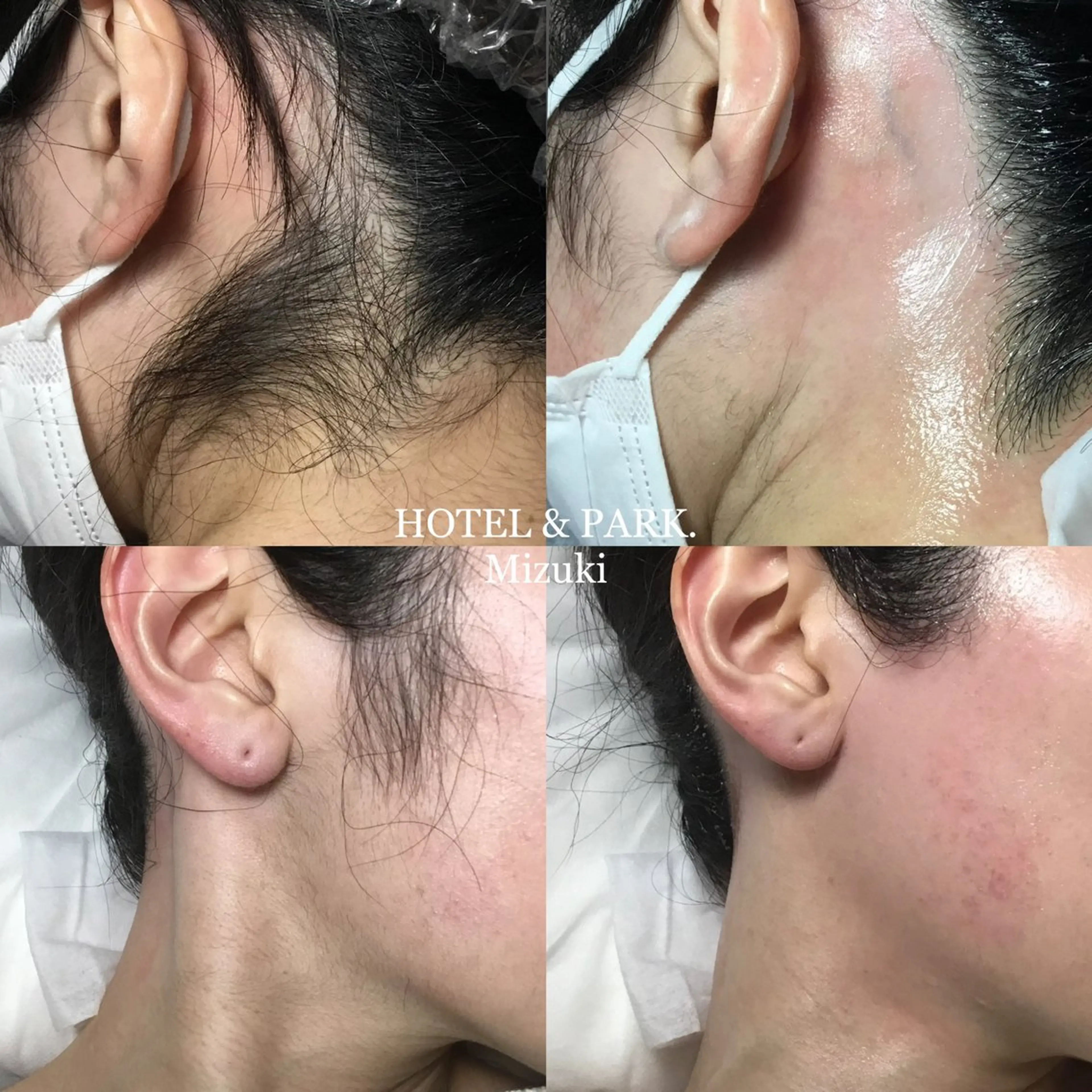 脱毛 HOTEL&PARK . ワックス脱毛のエステ・リラクイメージ