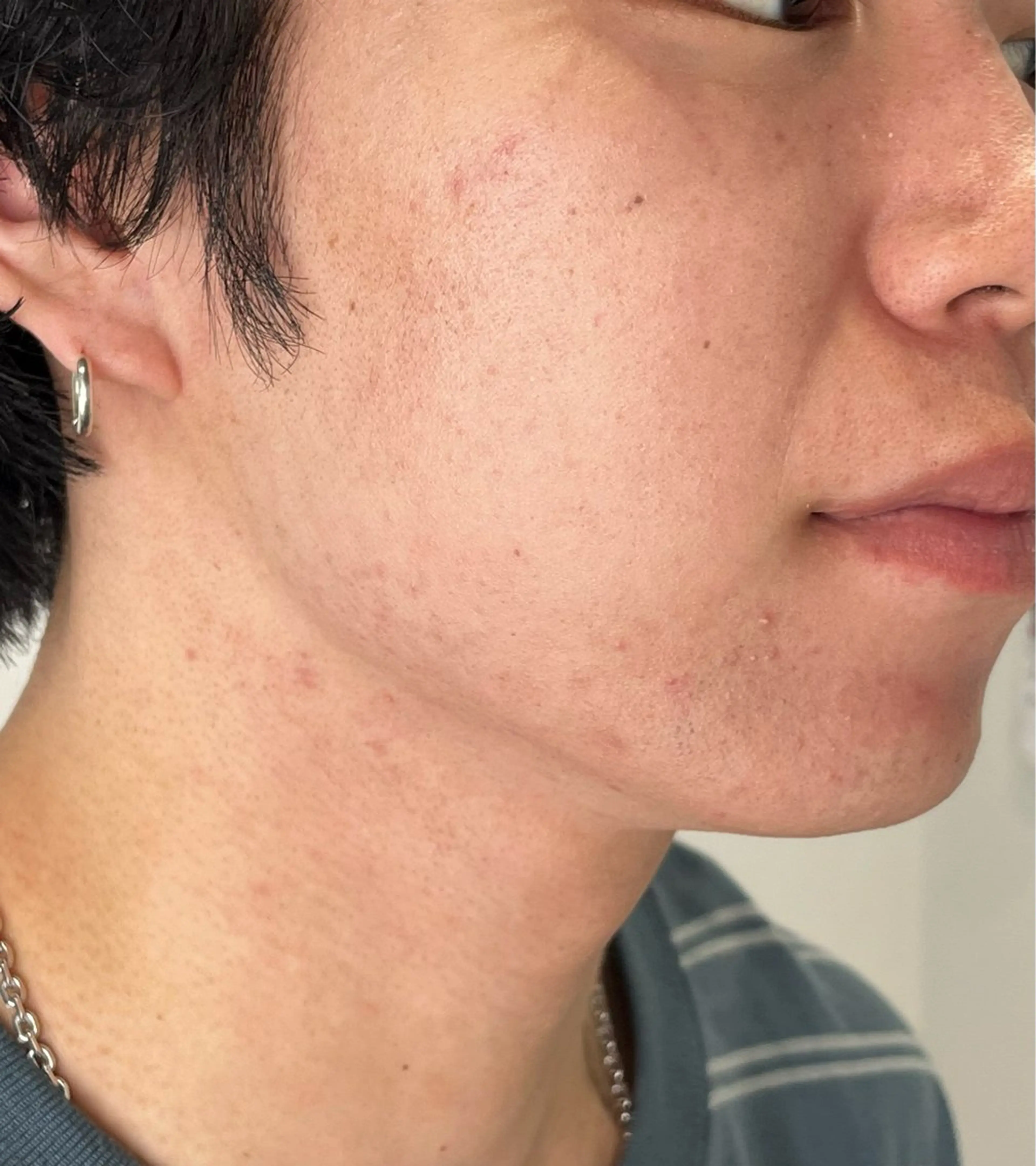 メンズヒゲ脱毛　【デザインヒゲ脱毛もこちらのメニューになります。】の写真