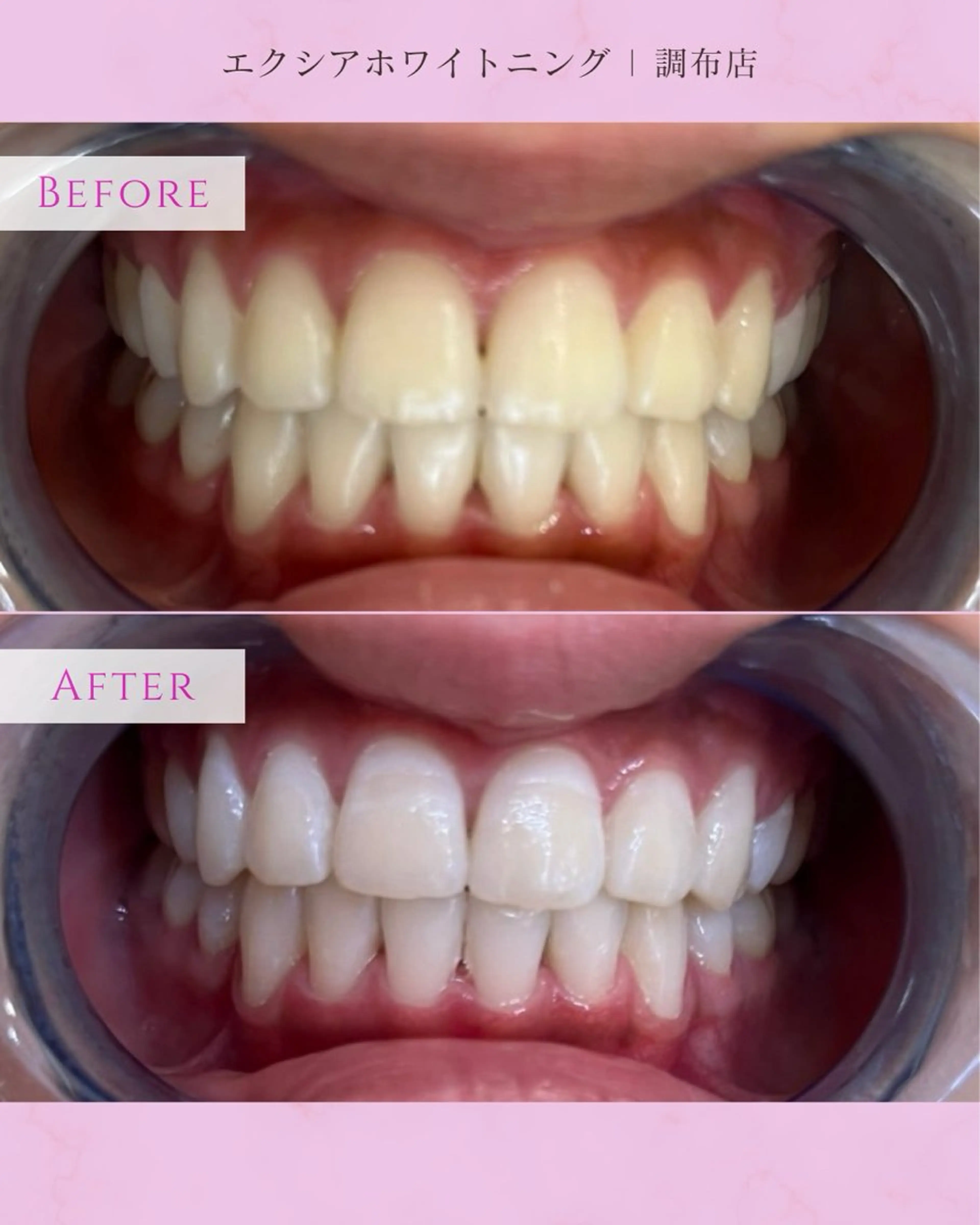 その他 エクシアホワイト調布所属・umi❤︎ ホワイトニングのその他イメージ