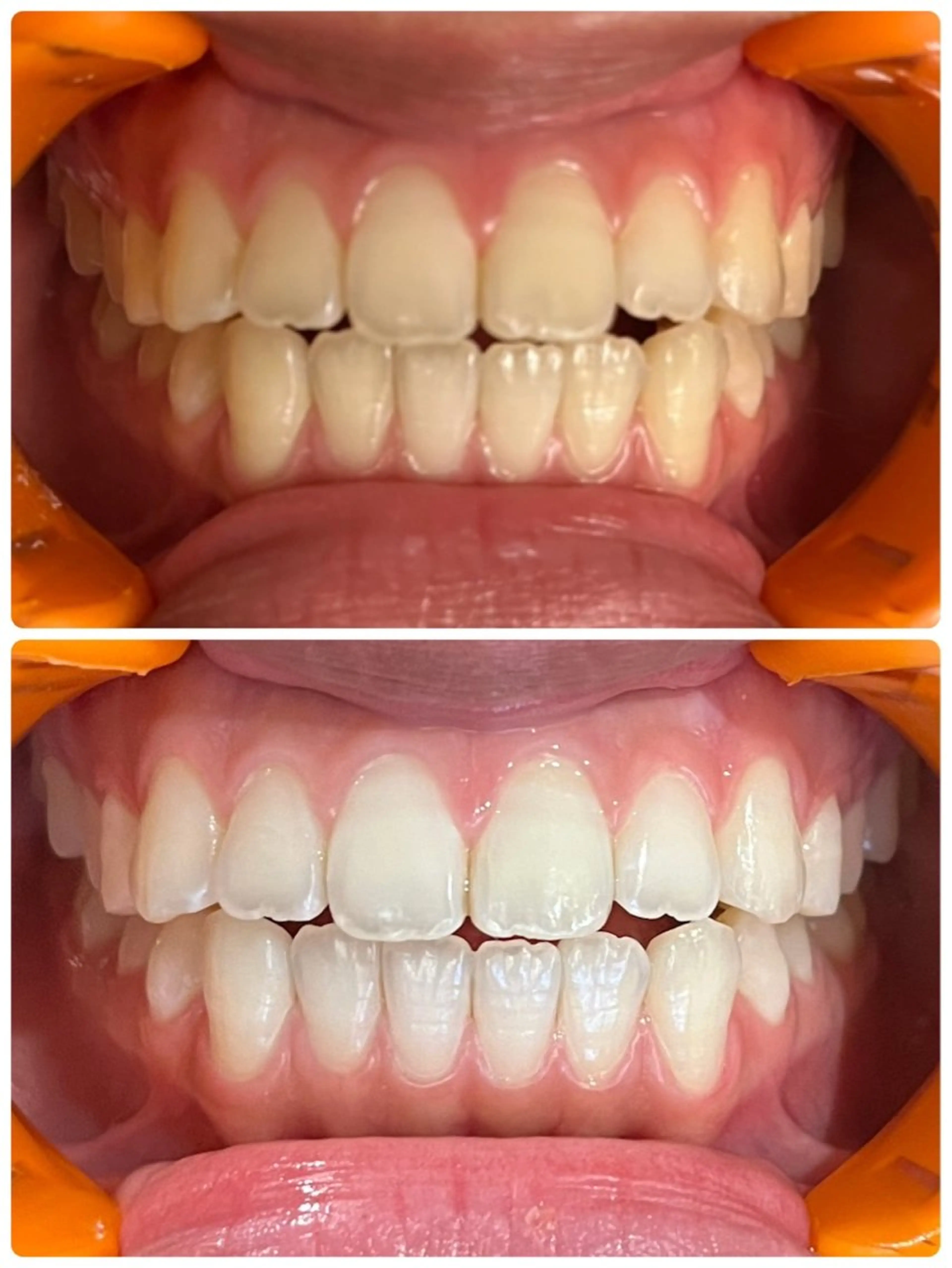 ホワイトニング３回照射の写真